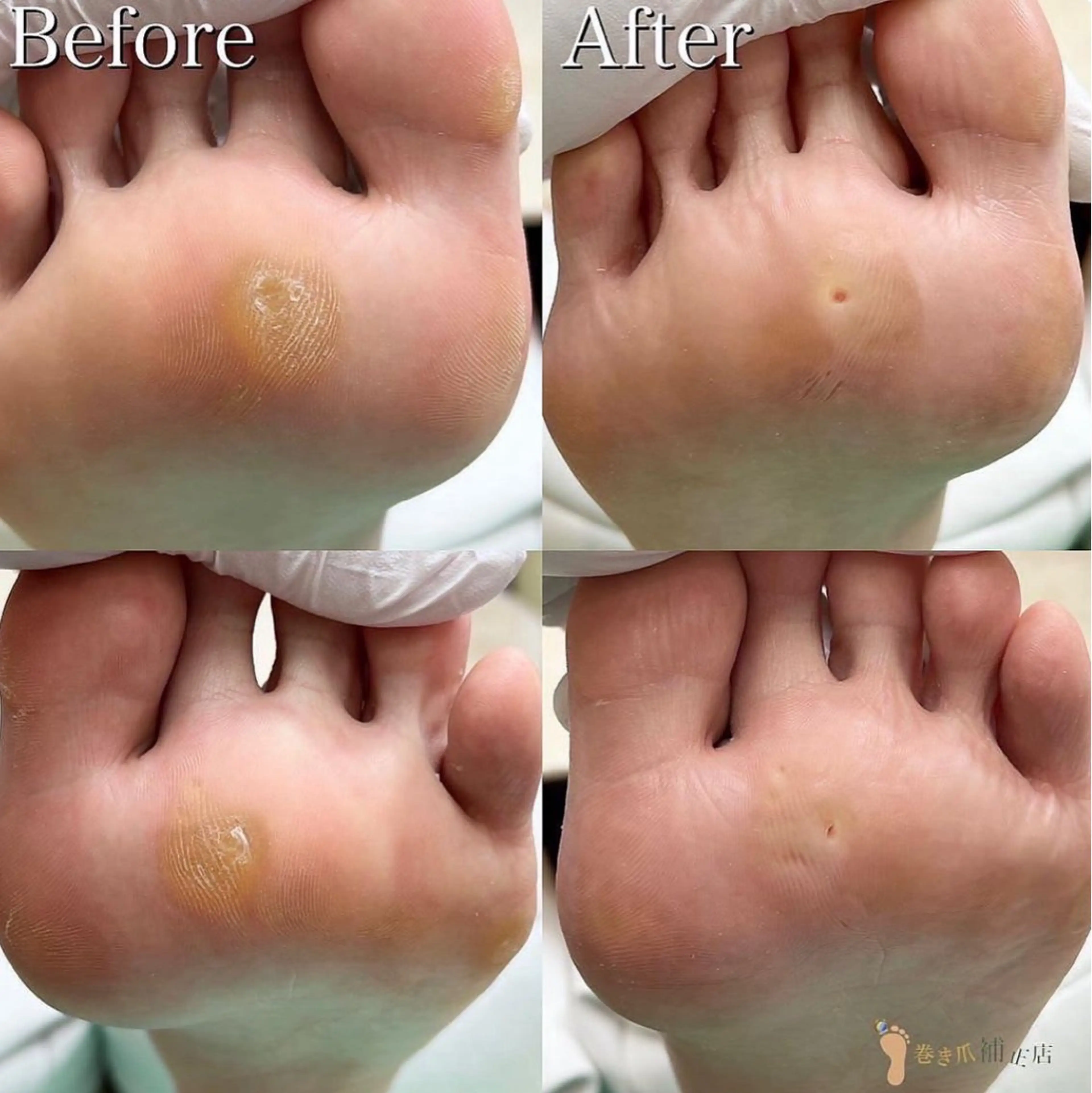 【足裏タコケア】足裏にできたゴワゴワ🌀角質もスベスベの足裏に✨是非お試しください💁‍♀️の写真