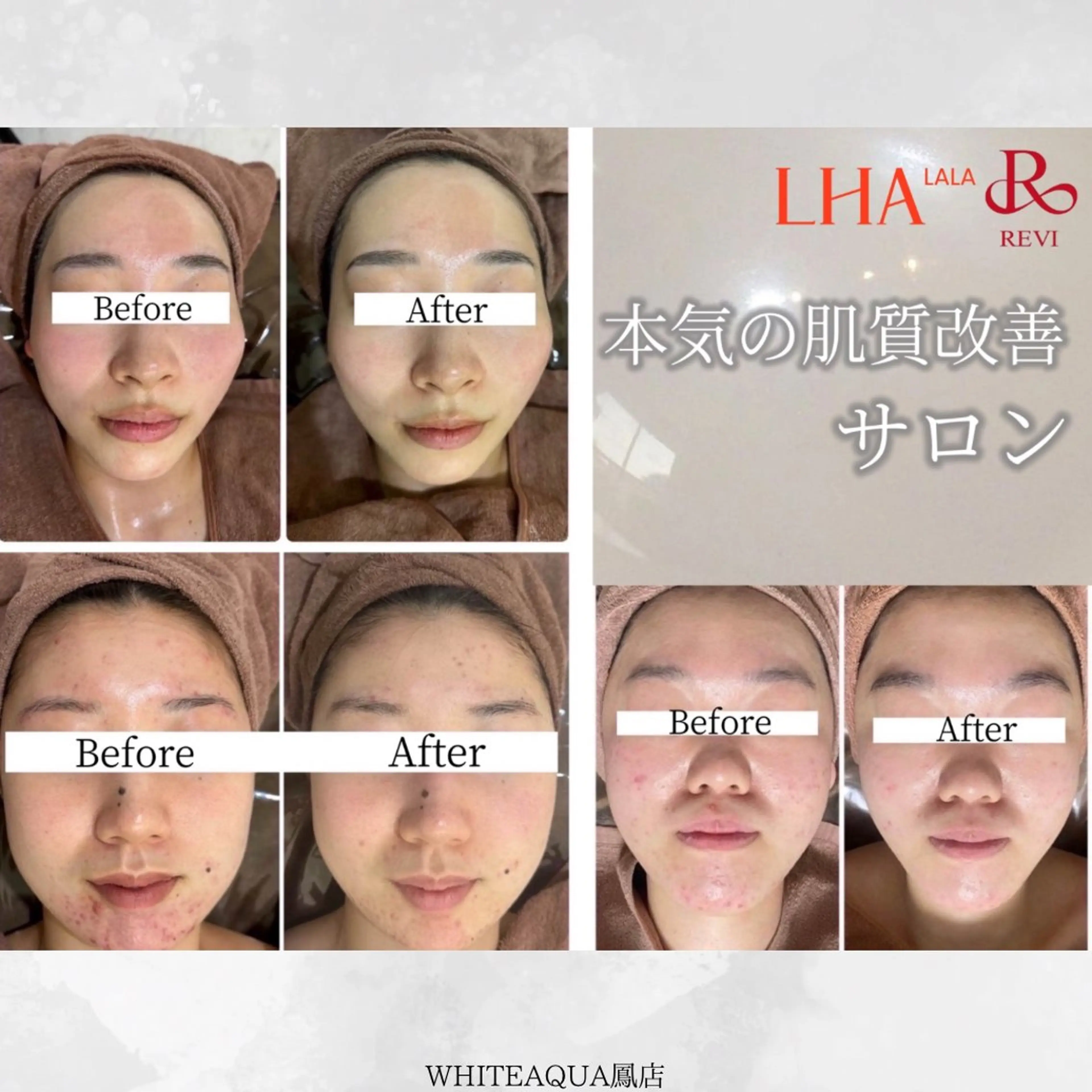 エステ リラク 毛穴・ニキビケア　ハーブピーリング【肌管理専門店】WHITE AQUA鳳店所属・ホワイトアクア 鳳店のエステ・リラクイメージ