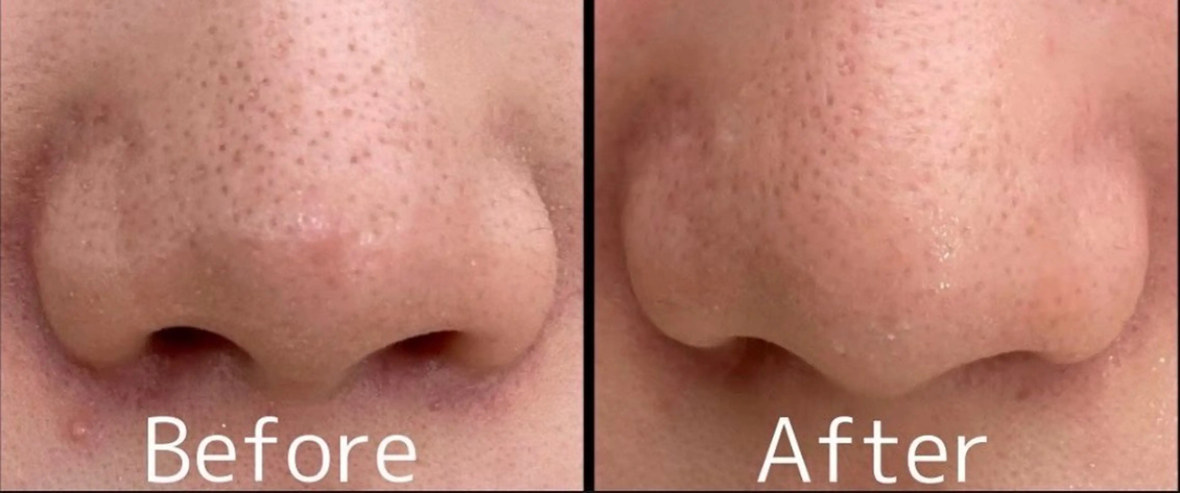 高濃度乳酸ピーリング付き光フェイシャル…毛穴開き、黒ずみ、くすみ、ざらつきの改善の写真