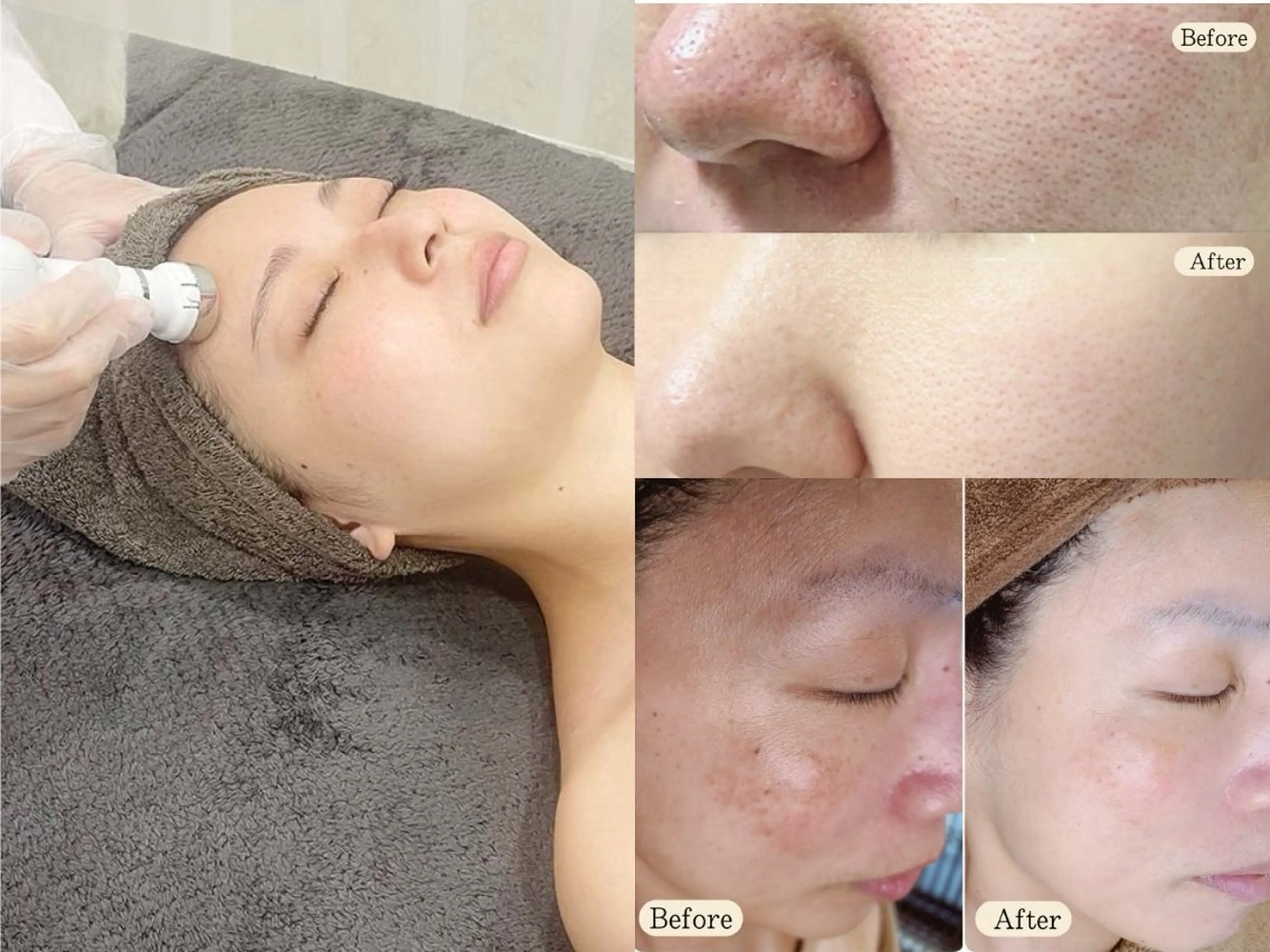 【韓国美容革命】シミ×白玉肌管理/毛穴・シミ・たるみを同時にケアする韓国式肌育成プラン◎痛みが少ない滑らかかな陶器肌を♪の写真