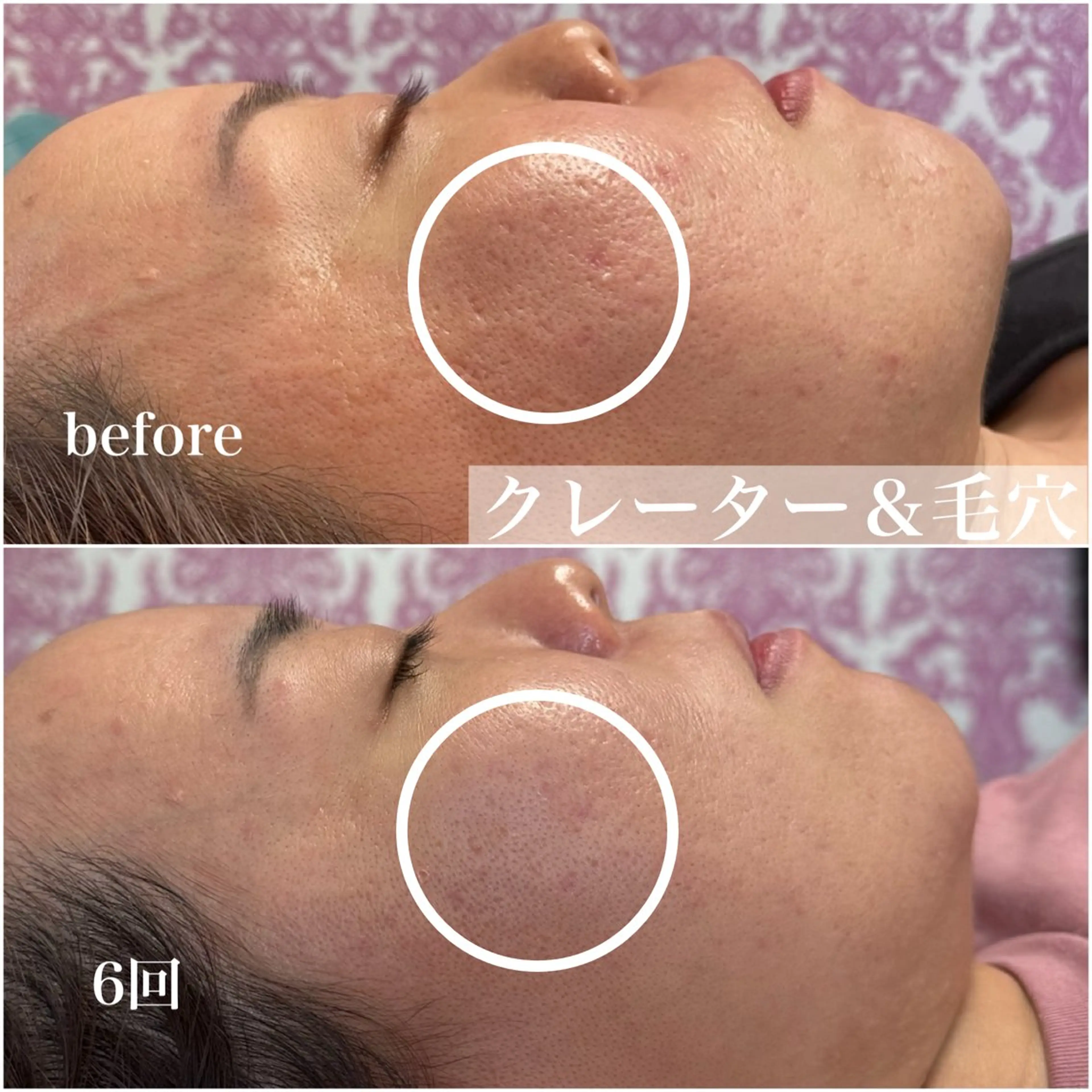 毛穴レス ハーブ＆ ワックス脱毛×光脱毛のエステ・リラクイメージ