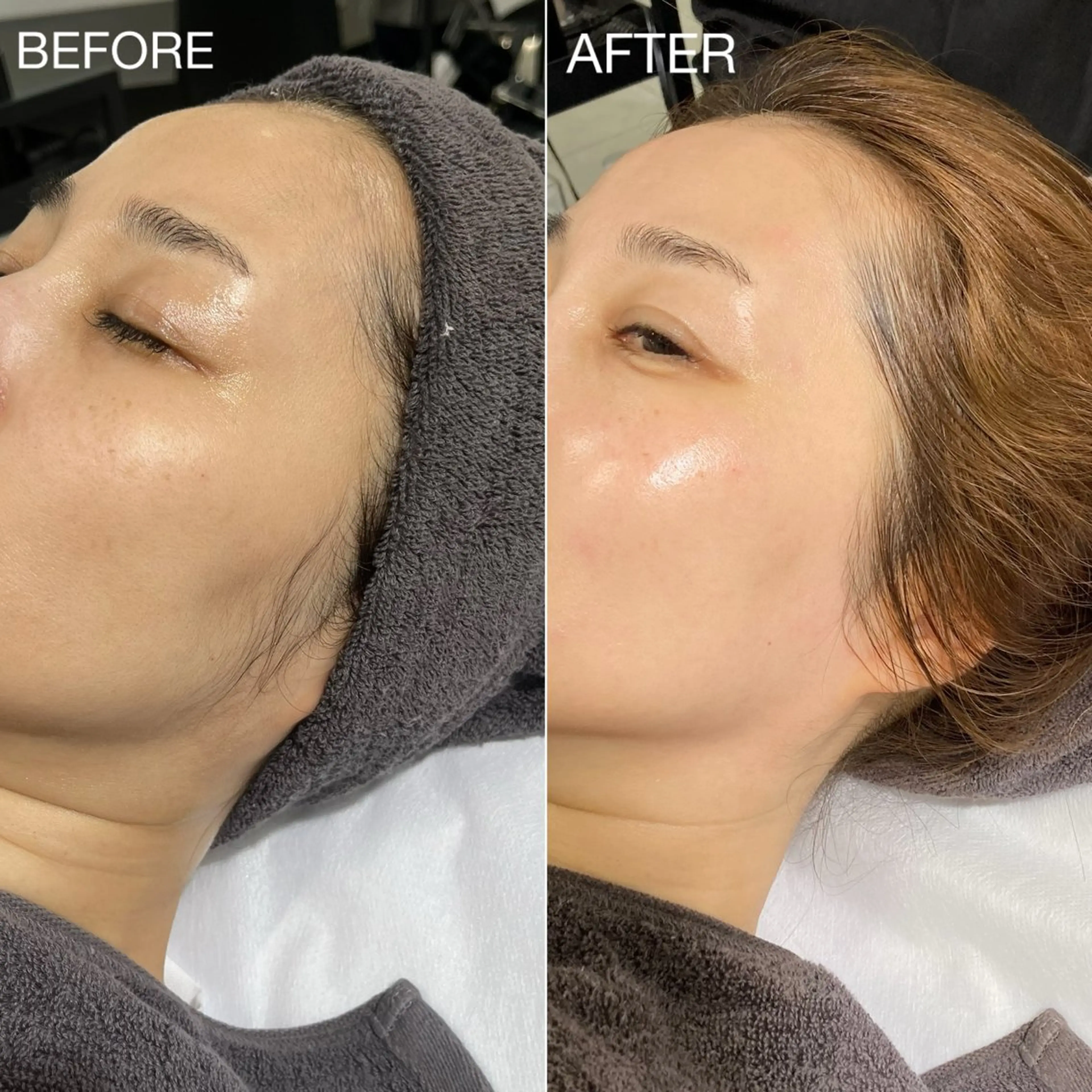 【ご新規様のみ✴︎平日限定】HBL認定サロン🖤艶肌フェイスワックス脱毛《2回目以降¥8800》の写真