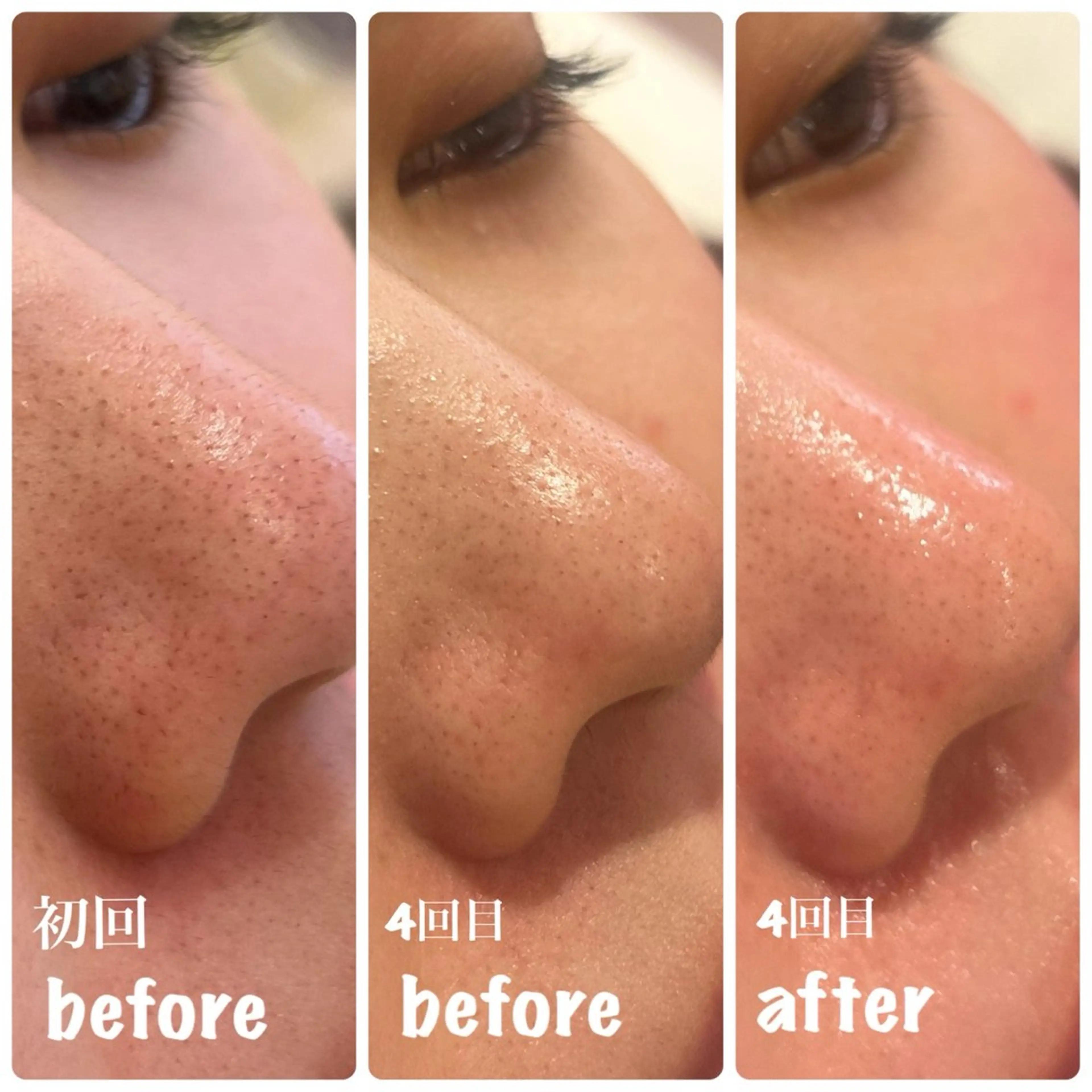 白玉肌土台作り🪞✨ハイドラ×高濃度ビタミンC超音波導入🍋🫧【発光肌・効果実感】の写真