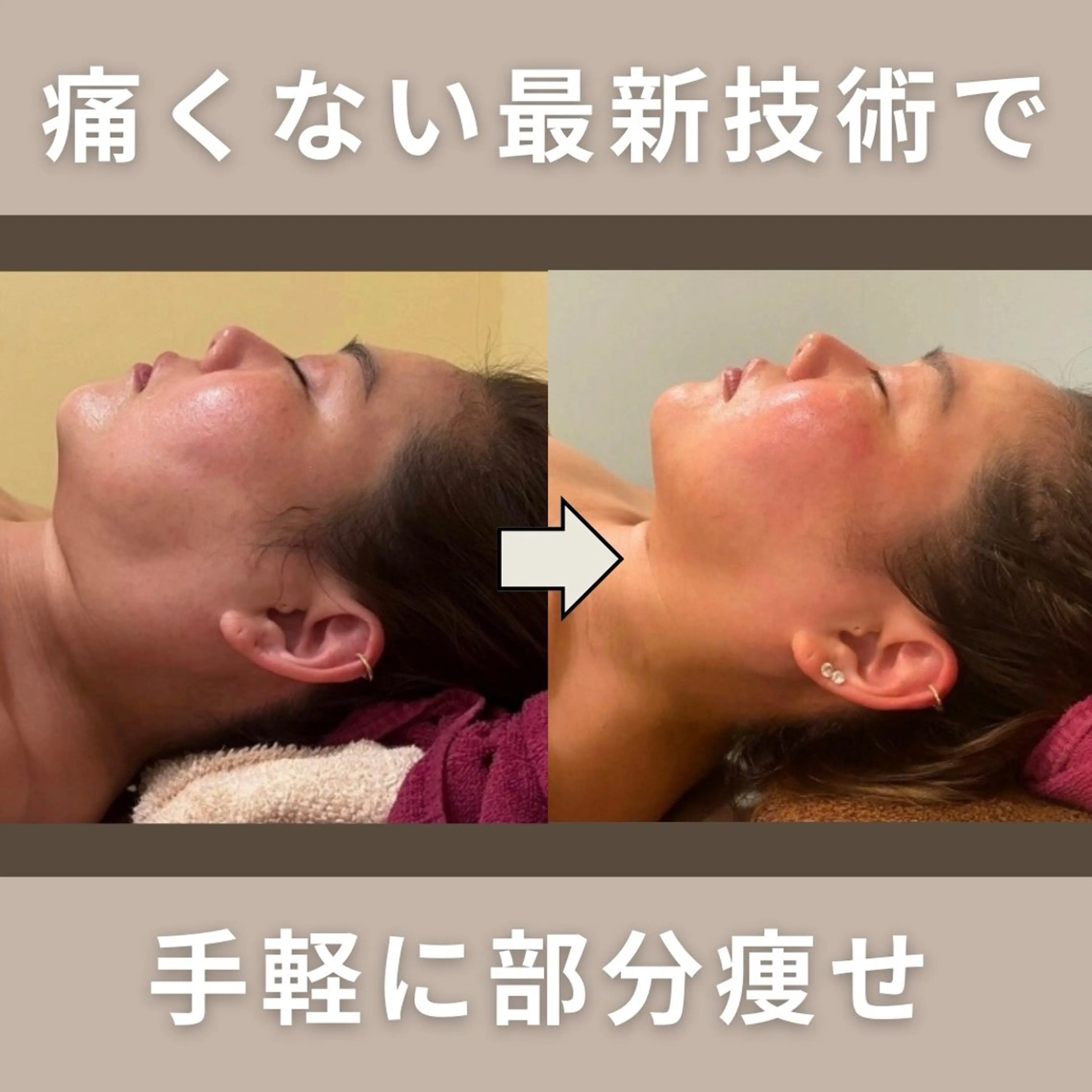 【小顔】フェイスラインシェイプの写真