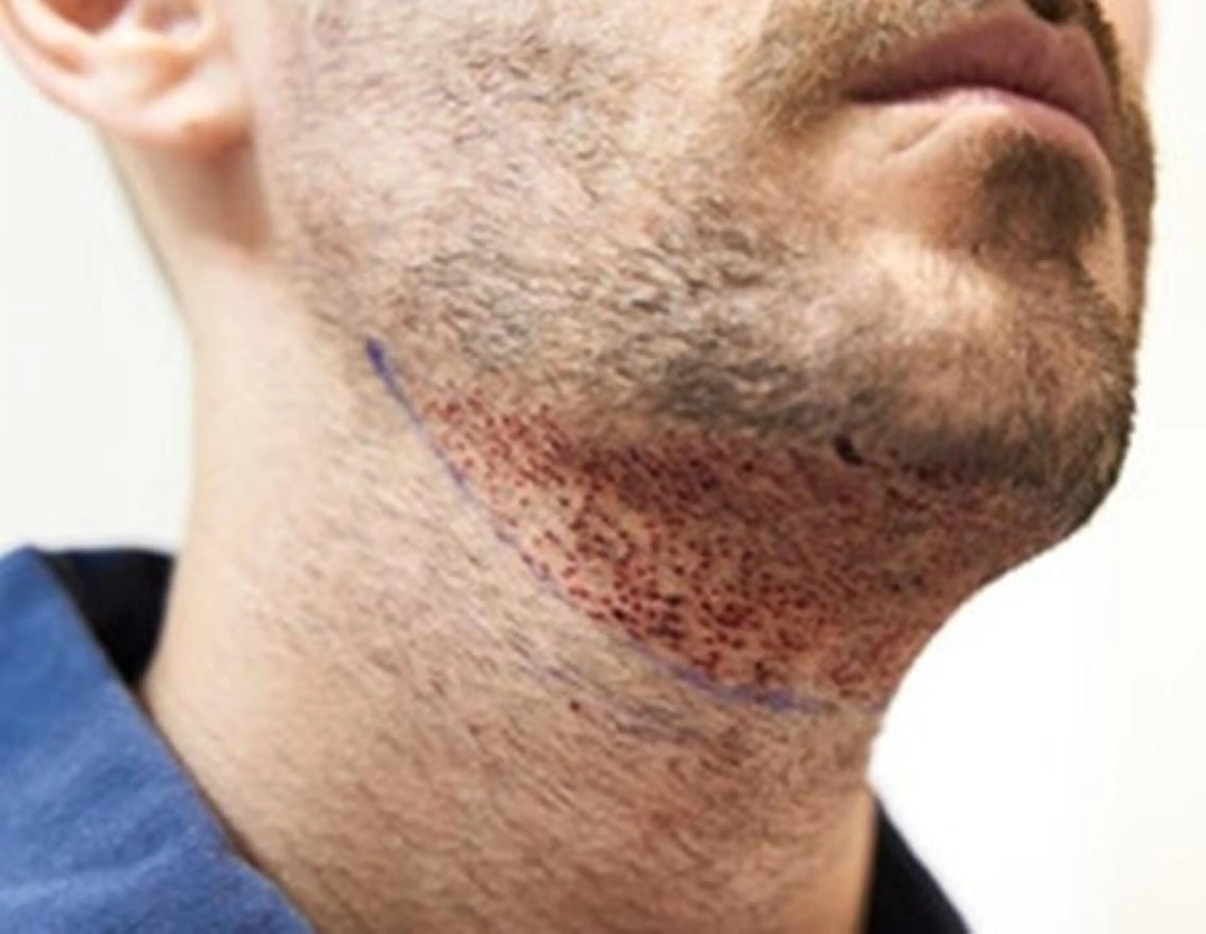 [メンズ脱毛カウンセリング]その場で完了1本処理の電気脱毛orIPL減退脱毛¥0の写真