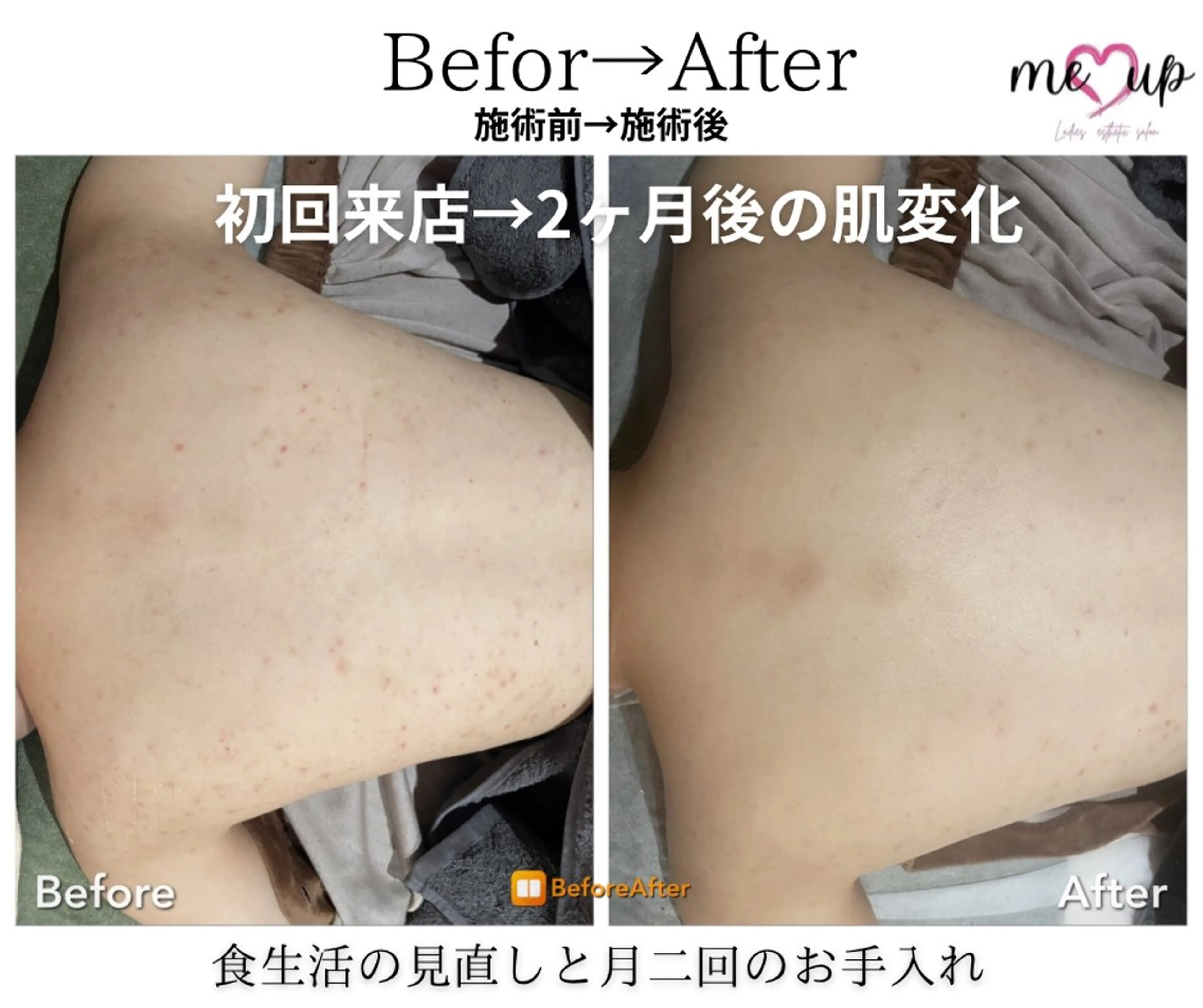 エステ Meupニキビ専門店 背中/ハーブ/肌管理のその他イメージ