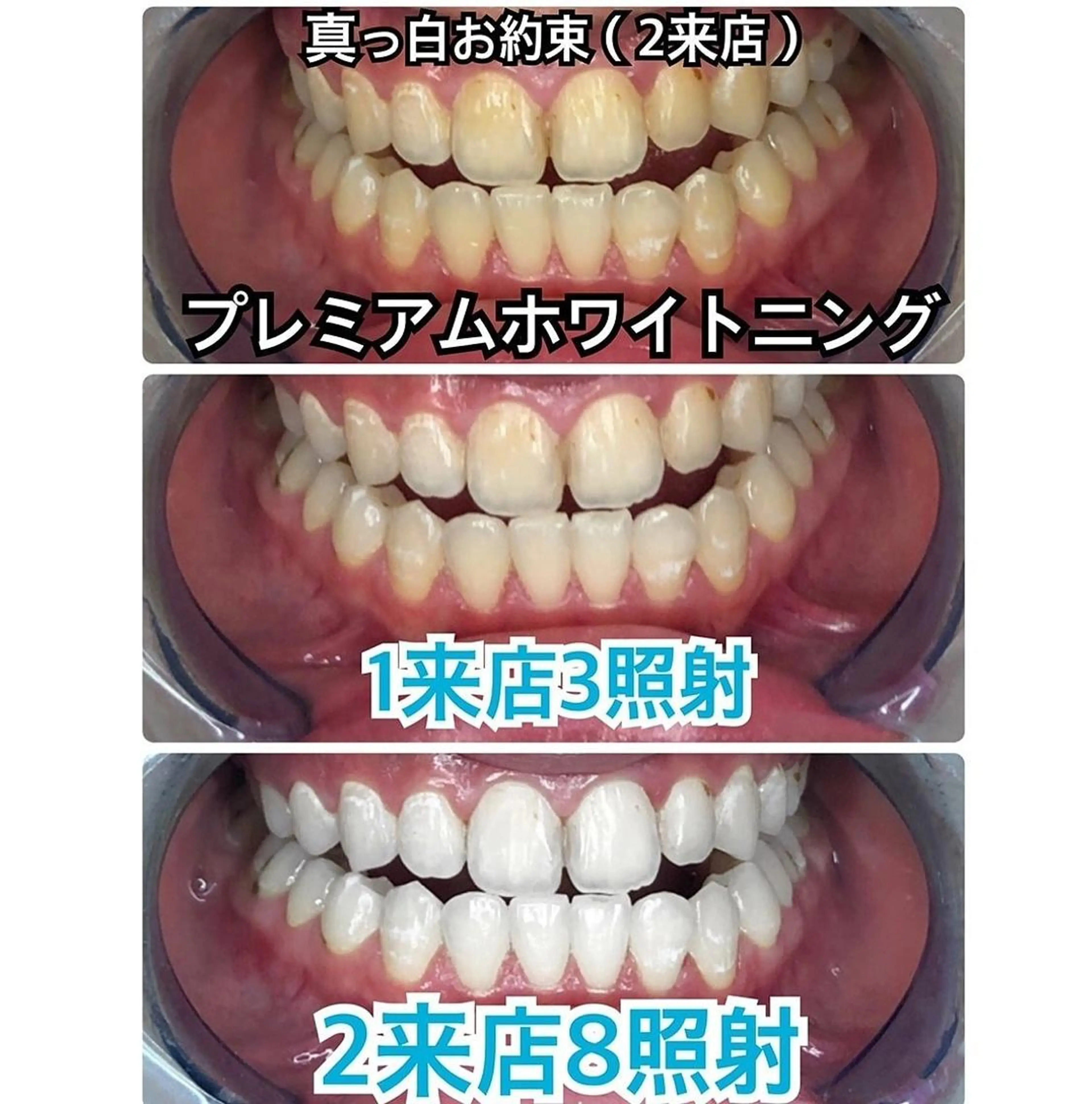【初回限定・白さを極める】真っ白お約束🦷プレミアムホワイトニング❣️〈合計8回照射2来店〉❣️😌✨の写真