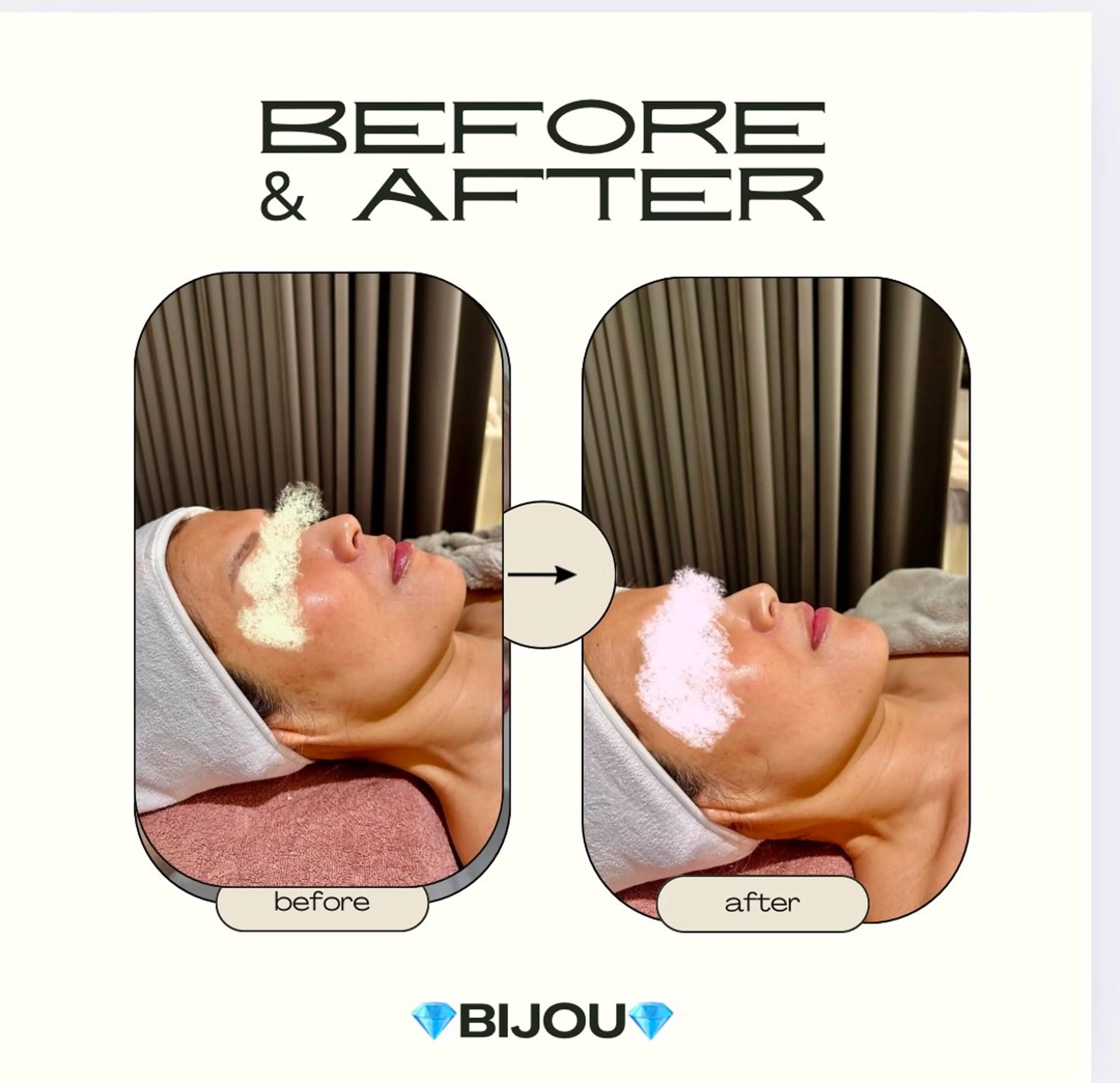 【ヒト幹細胞パック仕上げ】LDM水玉リフティングの写真