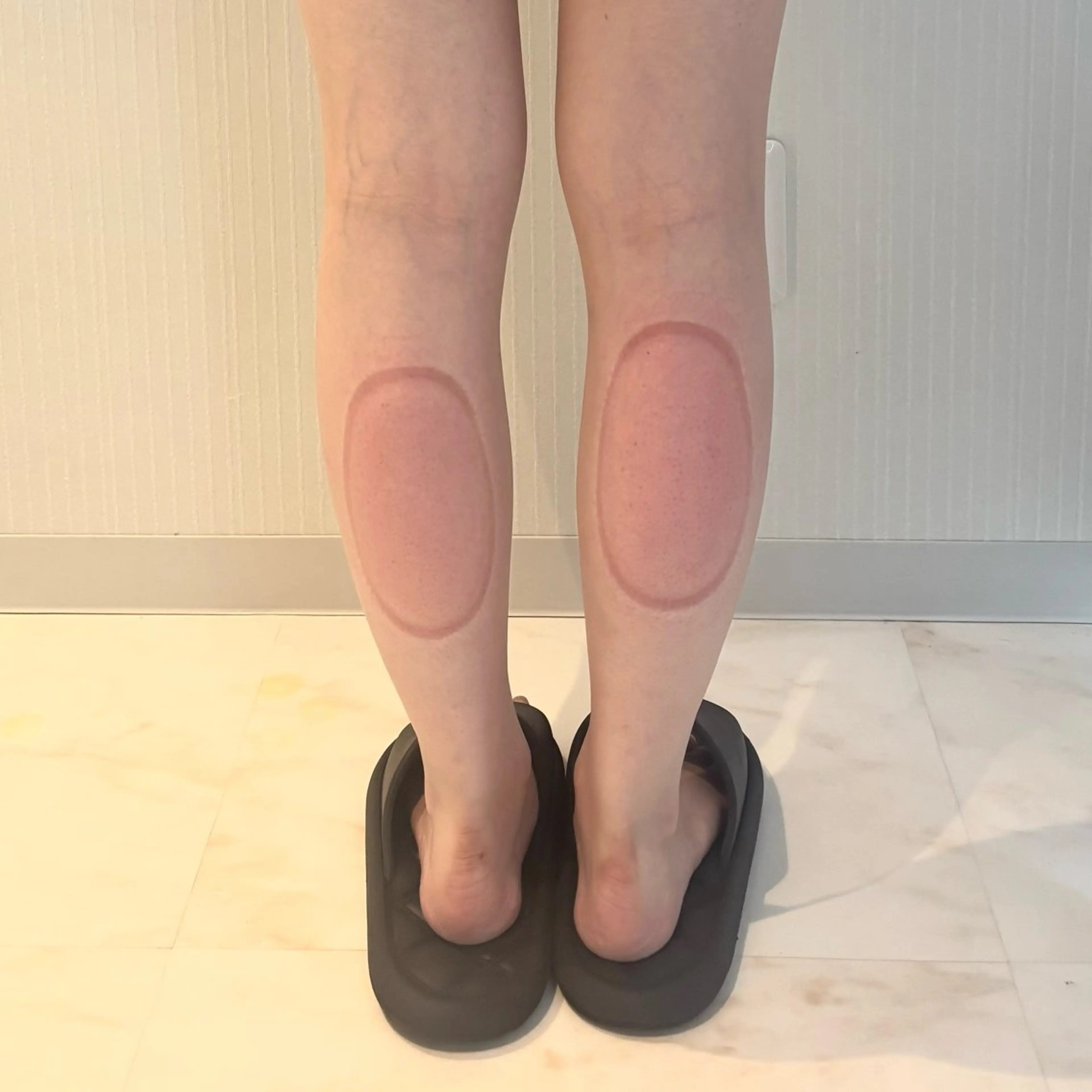 脂肪痩身〈ふくらはぎ〉初回体験2カップの写真