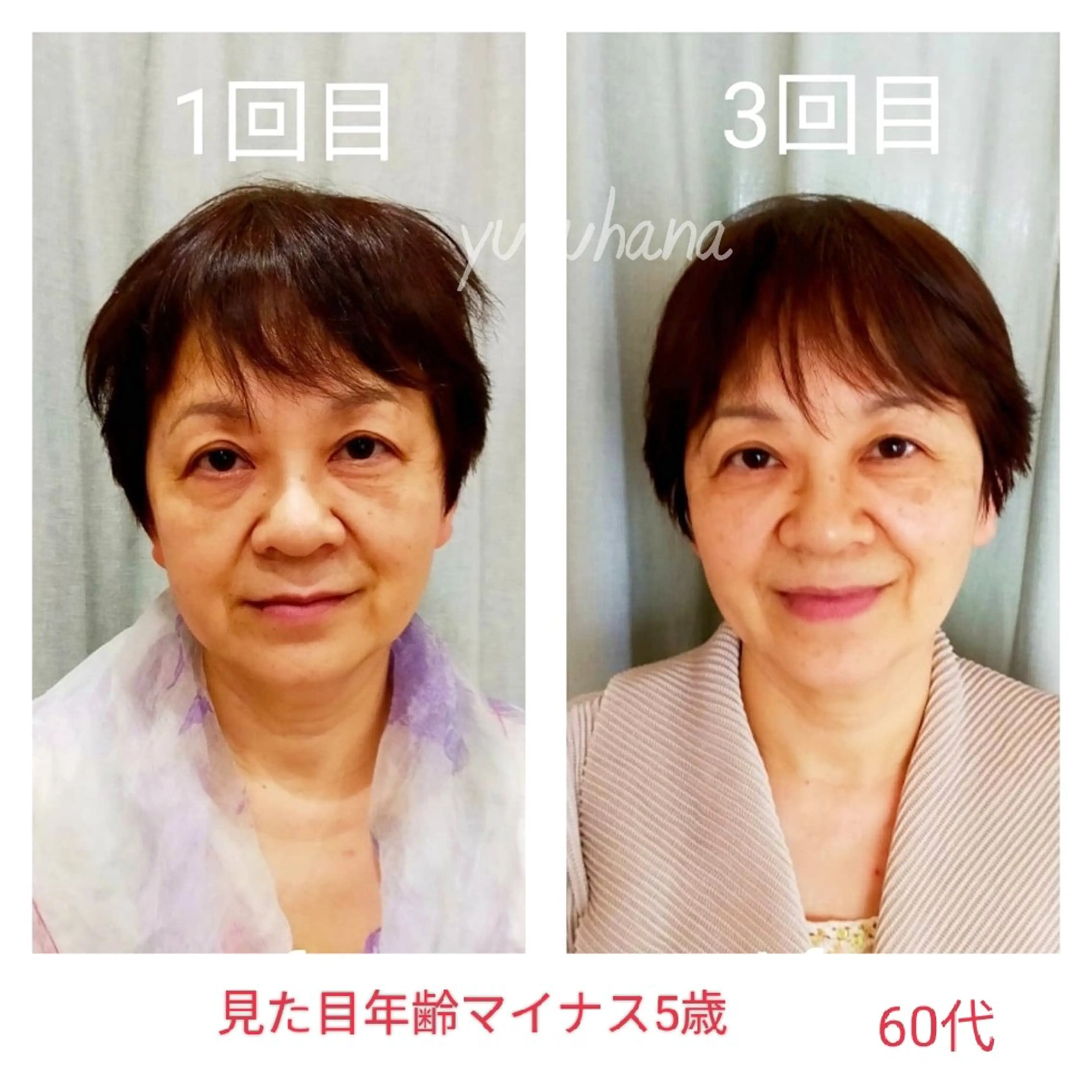 むくみスッキリ小顔コース《定番の基本コース❤️たるみ／むくみ／ほうれい線》45分の写真