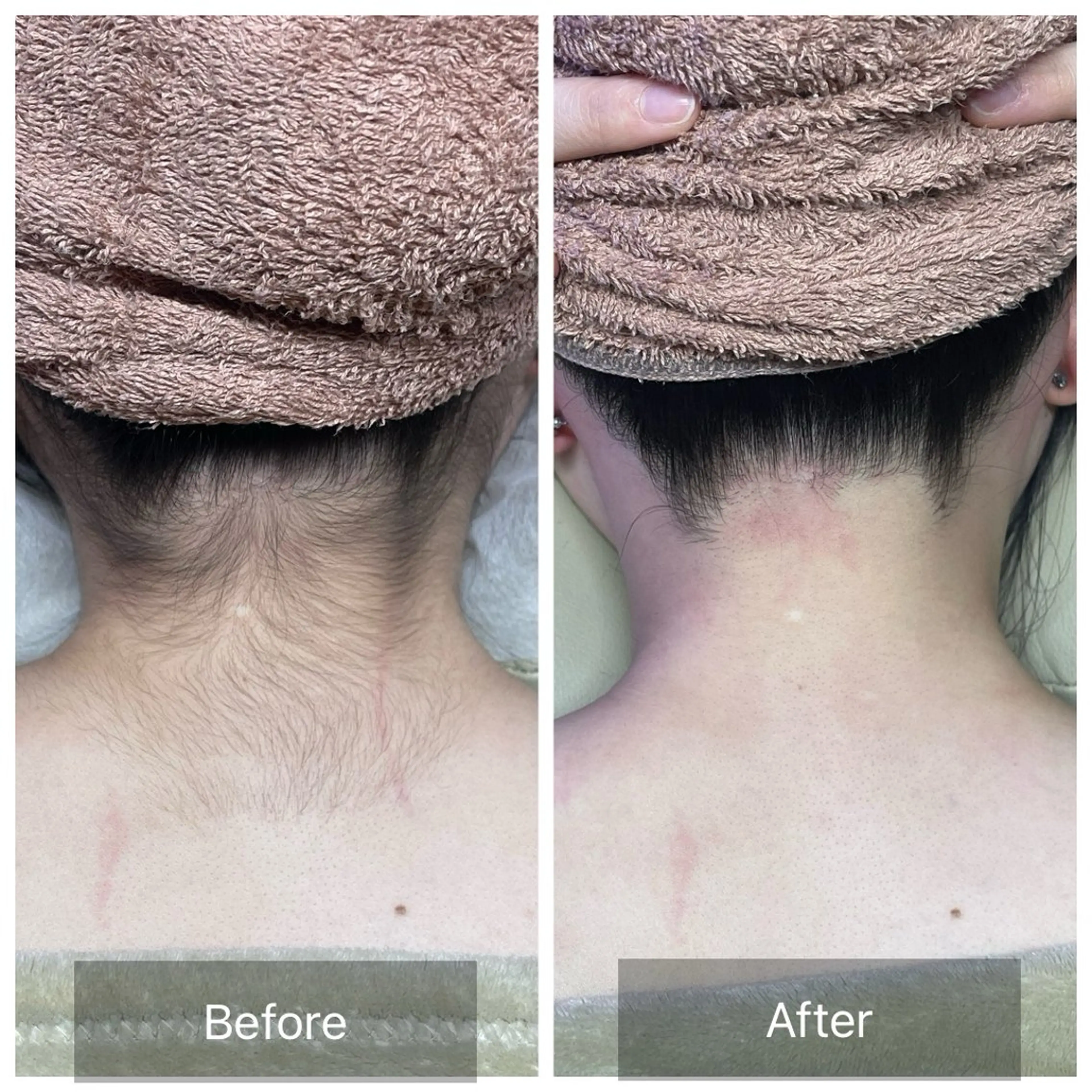 【✨️うなじ＋背中セット脱毛✨️】女性限定🎀夏に向けて後ろ姿まで美人へ✨️の写真