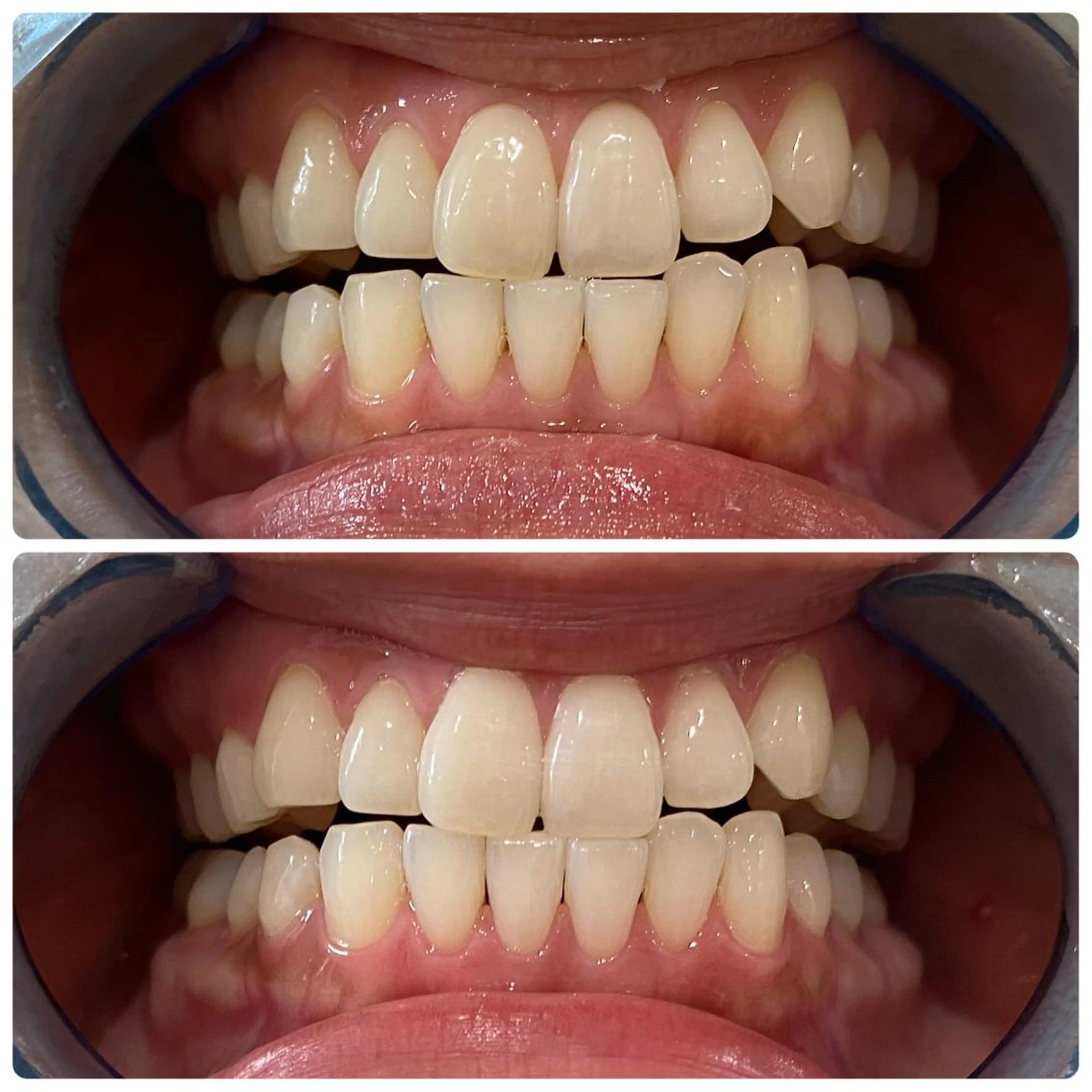 その他 White Berry SELF BEAUTY SALON所属・セルフホワイトニング 🦷口元垢抜け✨のその他イメージ