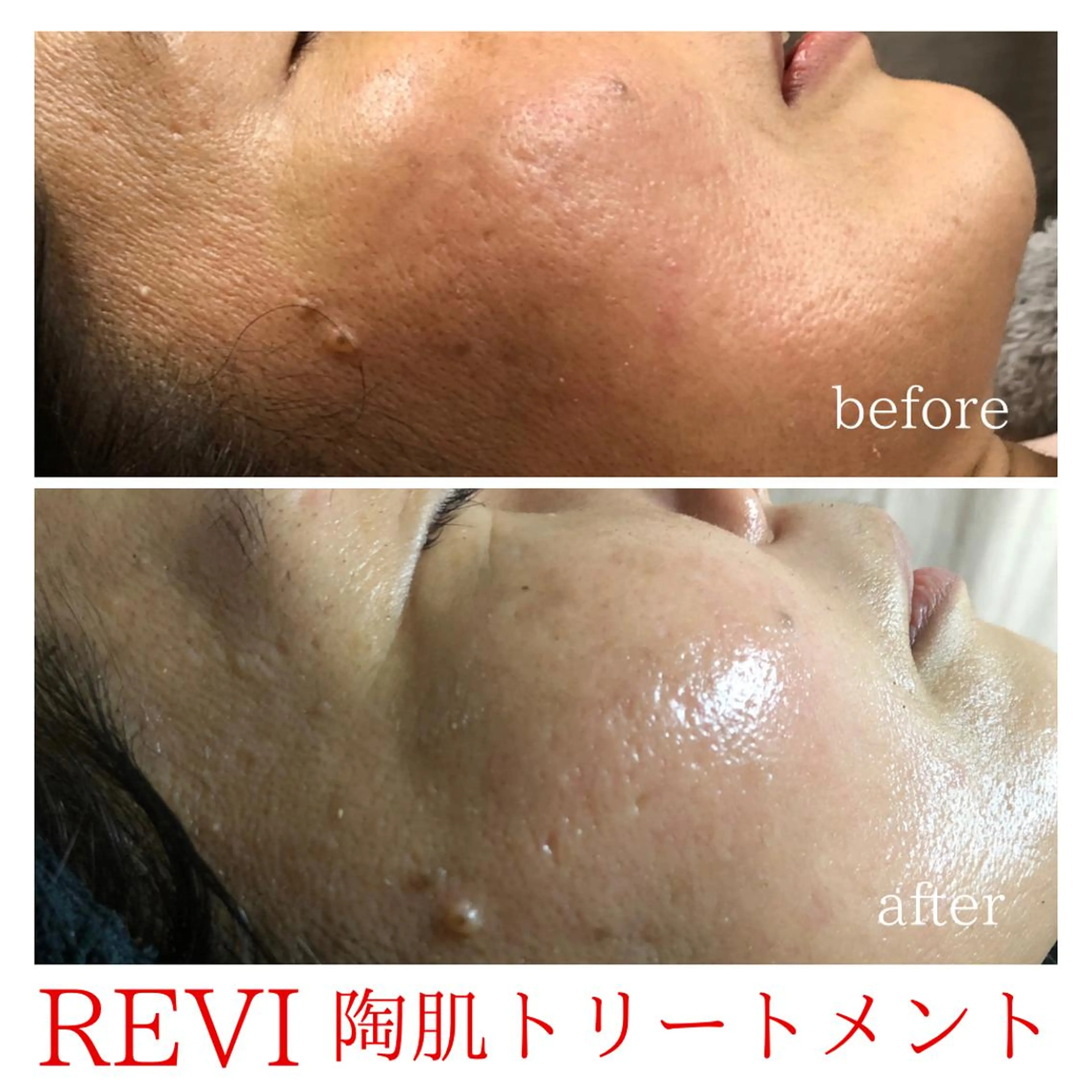 肌質改善REVI陶肌トリートメント✨ハーブ2g!!デコルテマッサージまたはドライヘッドスパ付き✨の写真