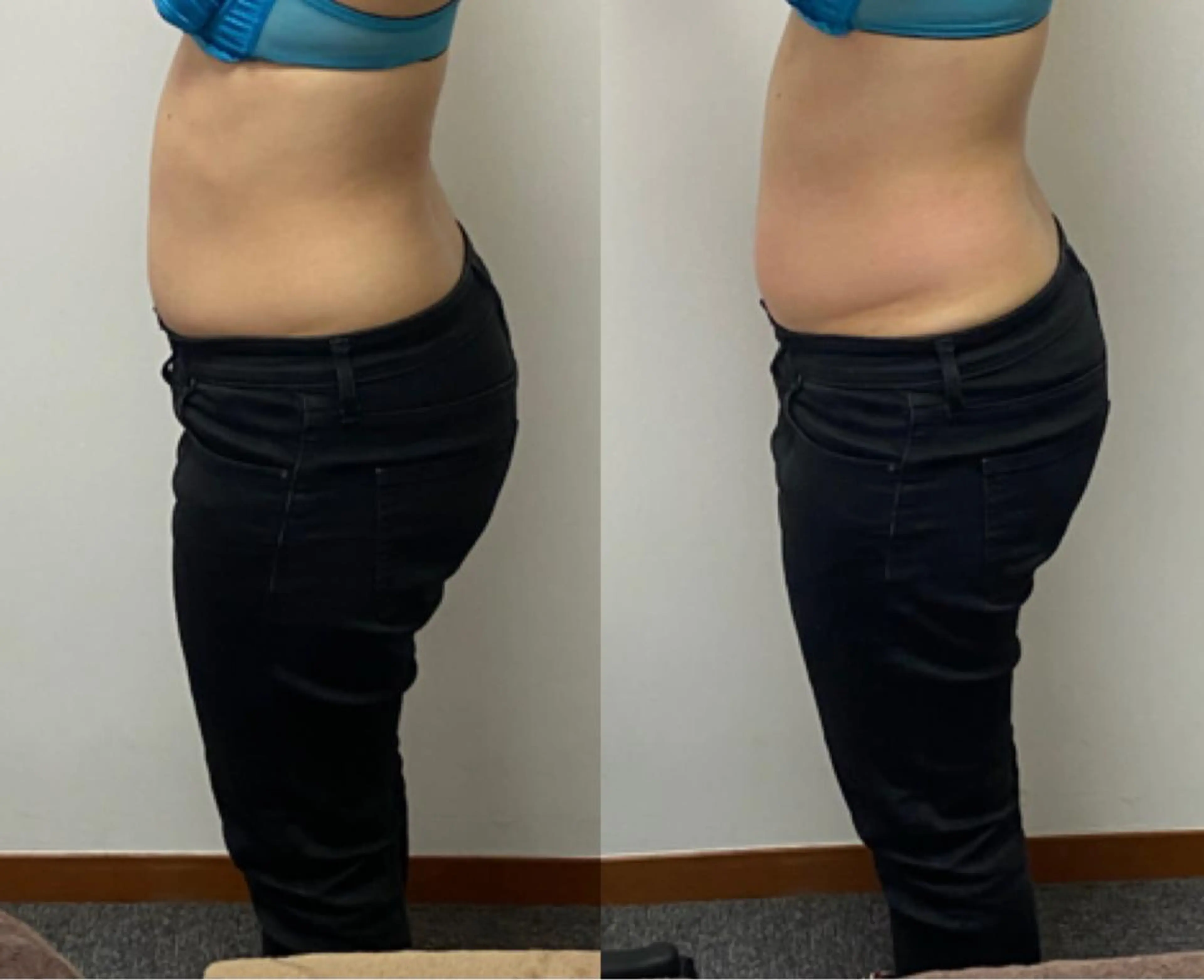 痩身機械が進化しました✨トリプル攻撃🤛キャビテーション&ラジオ波&吸引　部位：【お腹】の写真