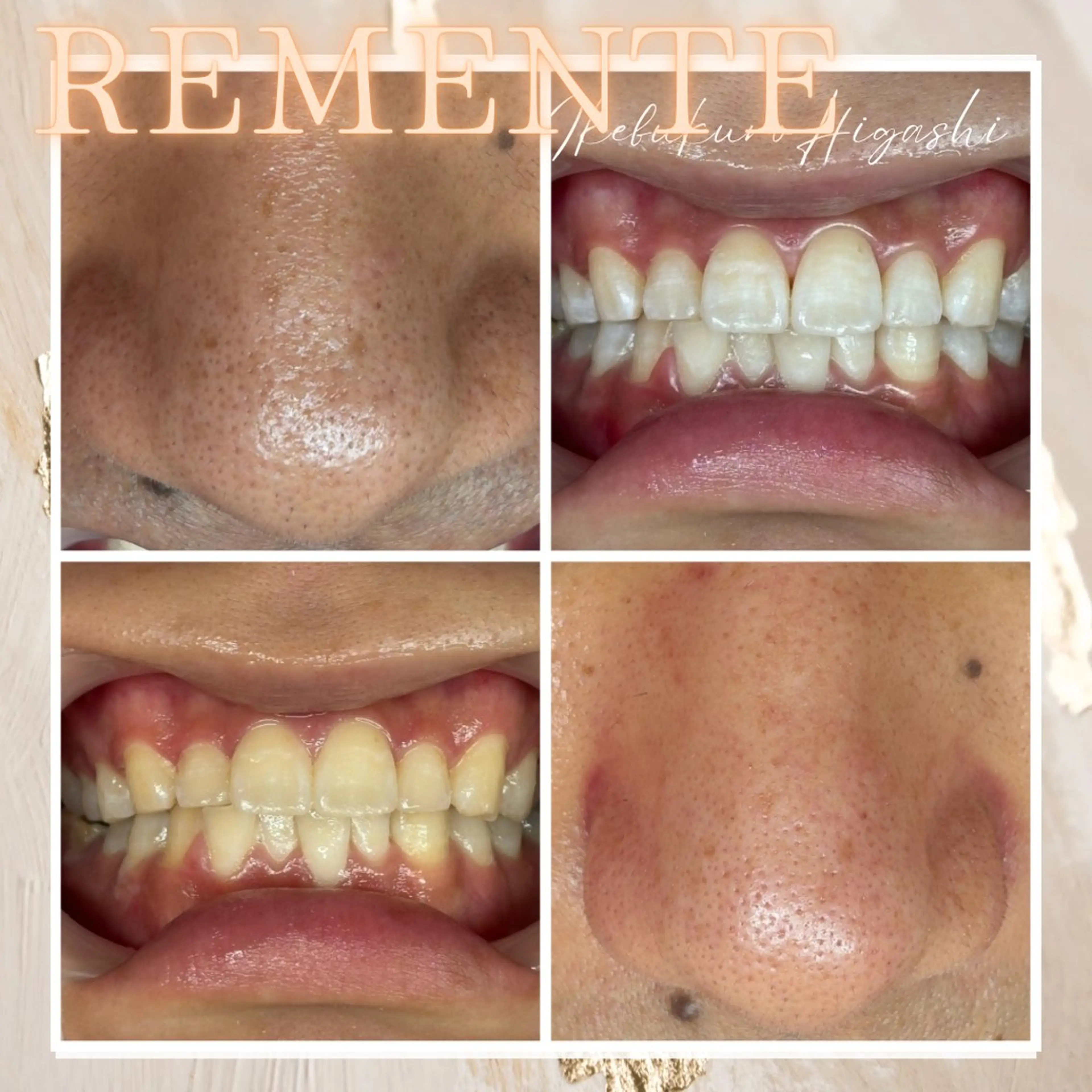 【ハイドラフェイシャル+ホワイトニング】今月3名様限定🌹大人気メニュー毛穴洗浄と紫LED照射ホワイトニングの同時施術✨の写真