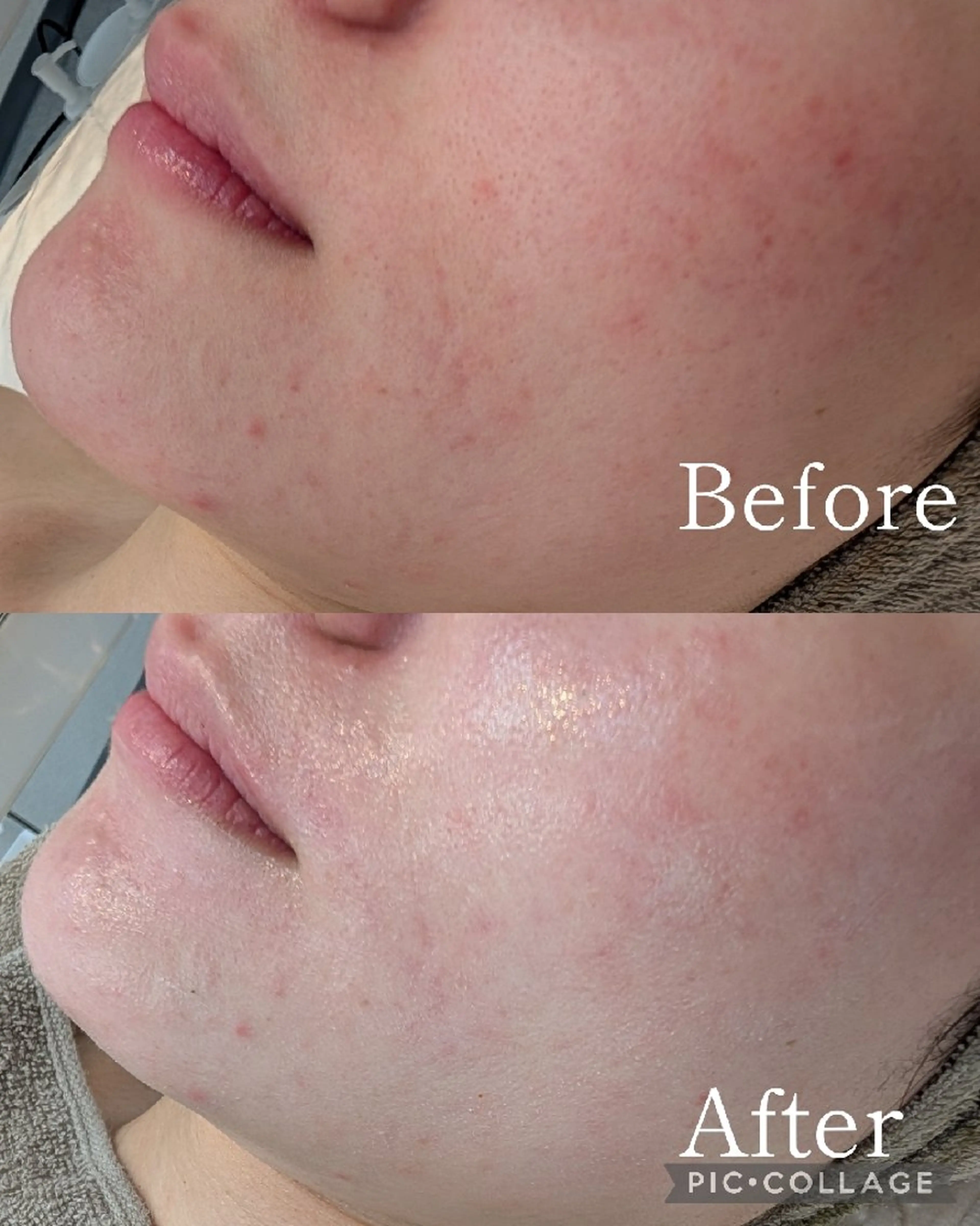 エステ 毛穴フェイシャルエステkokotto板橋所属・板橋美肌ハーブ ピーリング1位のエステ・リラクイメージ