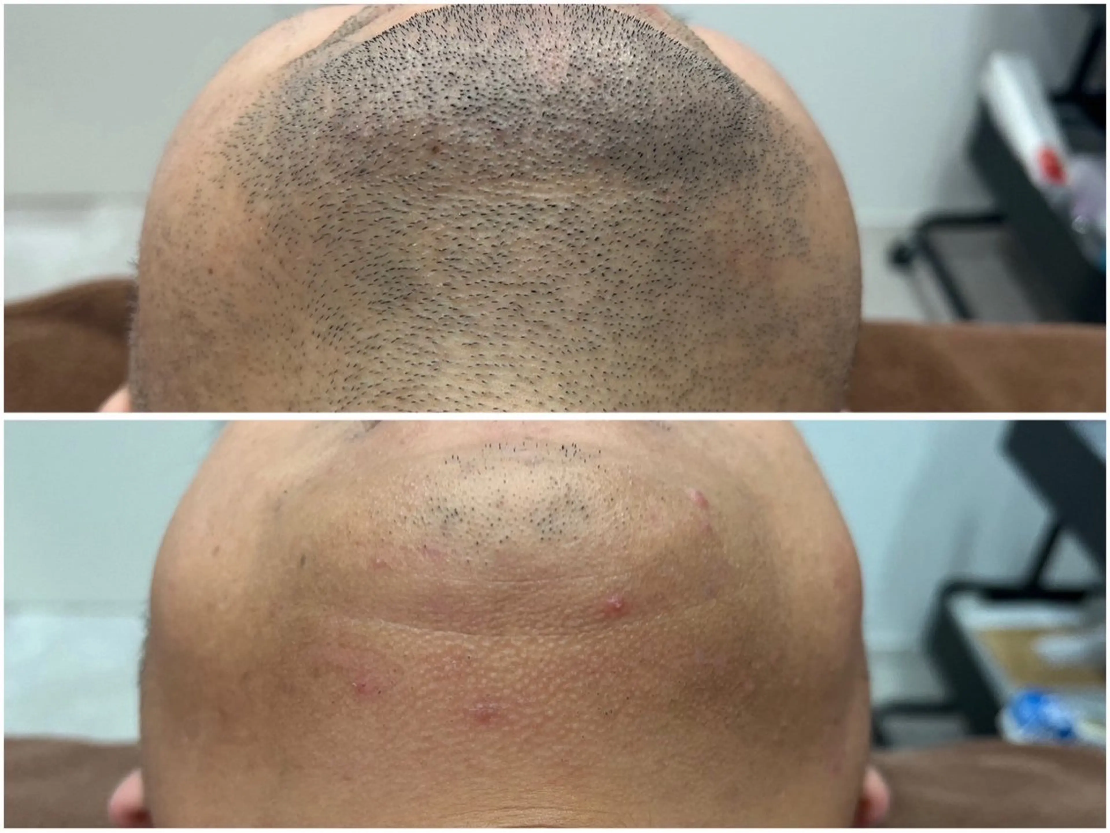 【男性人気NO.1】圧倒的抜け感！脱毛期間もツルツルが続く〈ひげ脱毛〉¥2000の写真