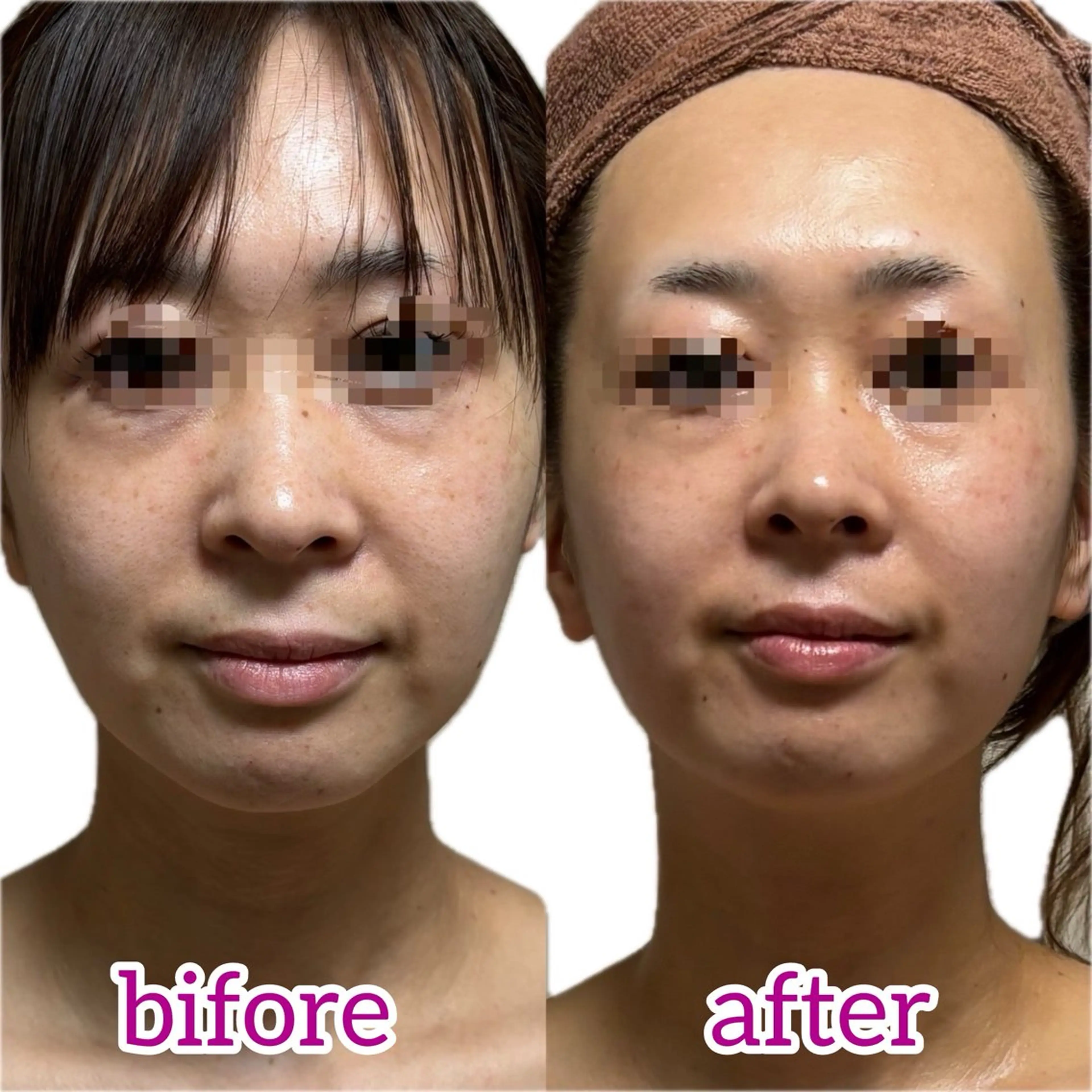 ✩肌質改善コース☆ツヤ肌★バクテリウムピール&フェイシャルマッサージ60分★ (所要時間 80分程度) 注意事項必読の写真