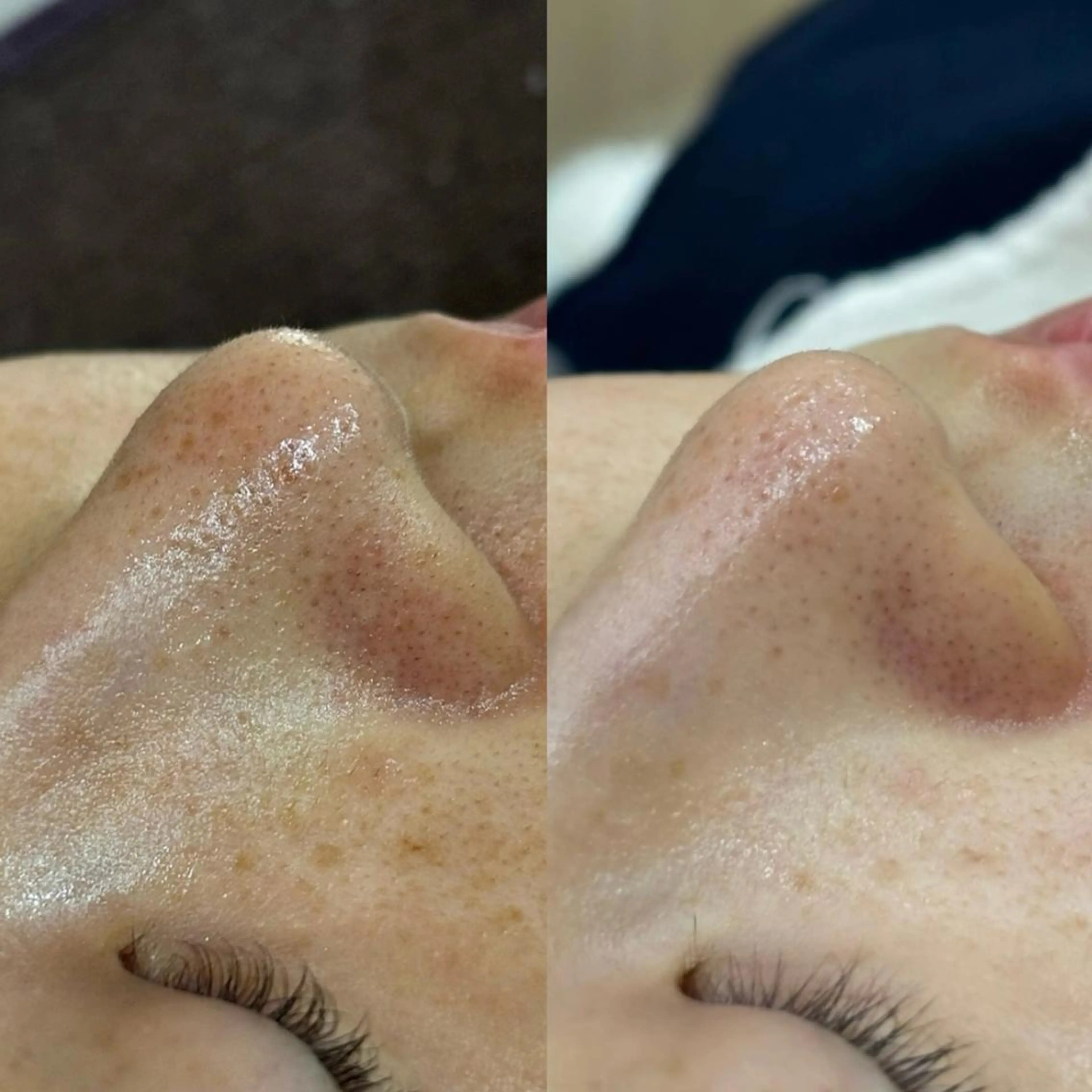 エステ Suu.千種/今池 毛穴洗浄/韓国肌管理のエステ・リラクイメージ