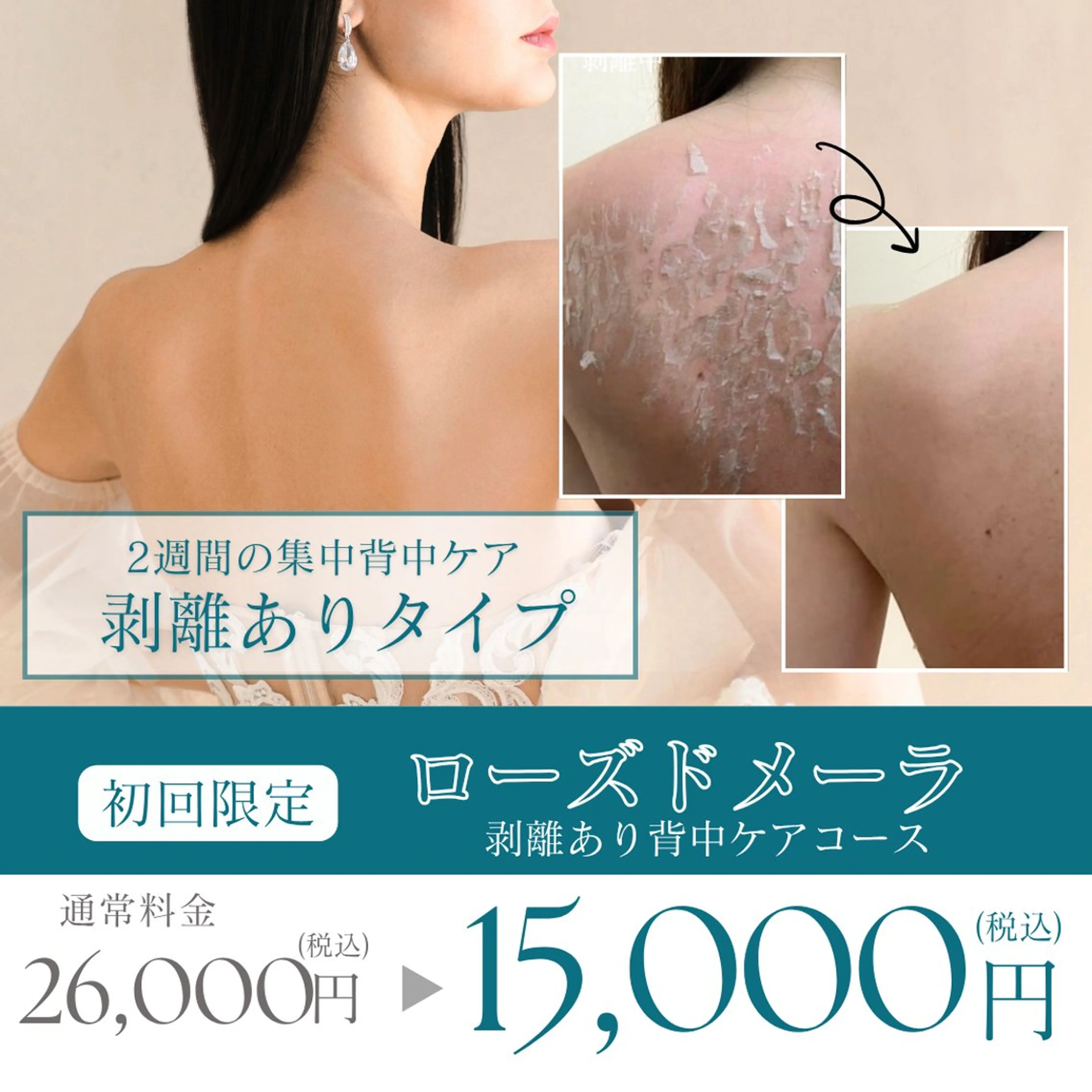 【剥離あり背中ケア】剥離ありハーブピーリング(ローズドメーラ)で根本から肌質ケア◎※7​〜​14日間の本格集中プログラムの写真