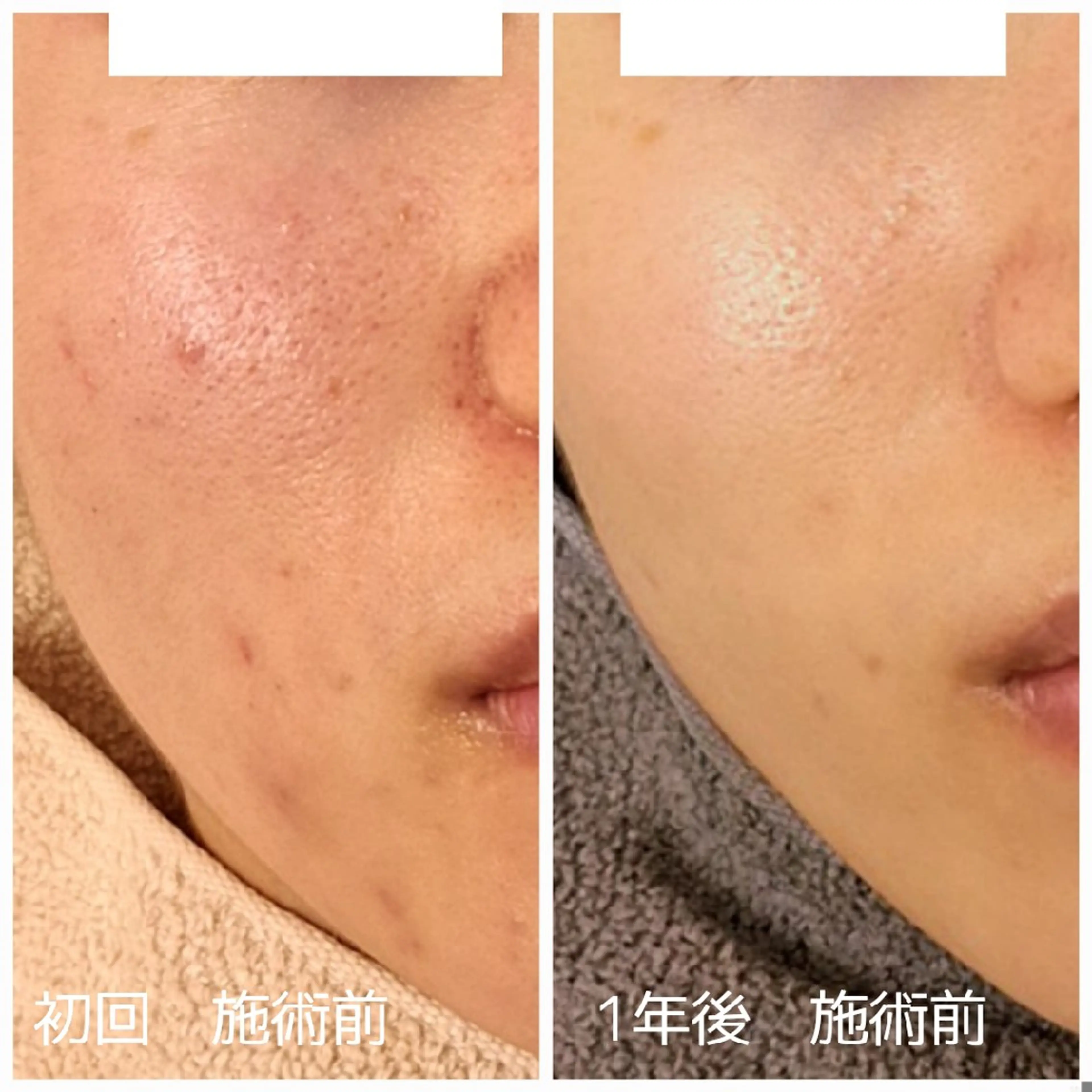 【ゴワつき】角質除去ピーリング+毛穴洗浄&血流リンパマッサージ+美容液導入の写真