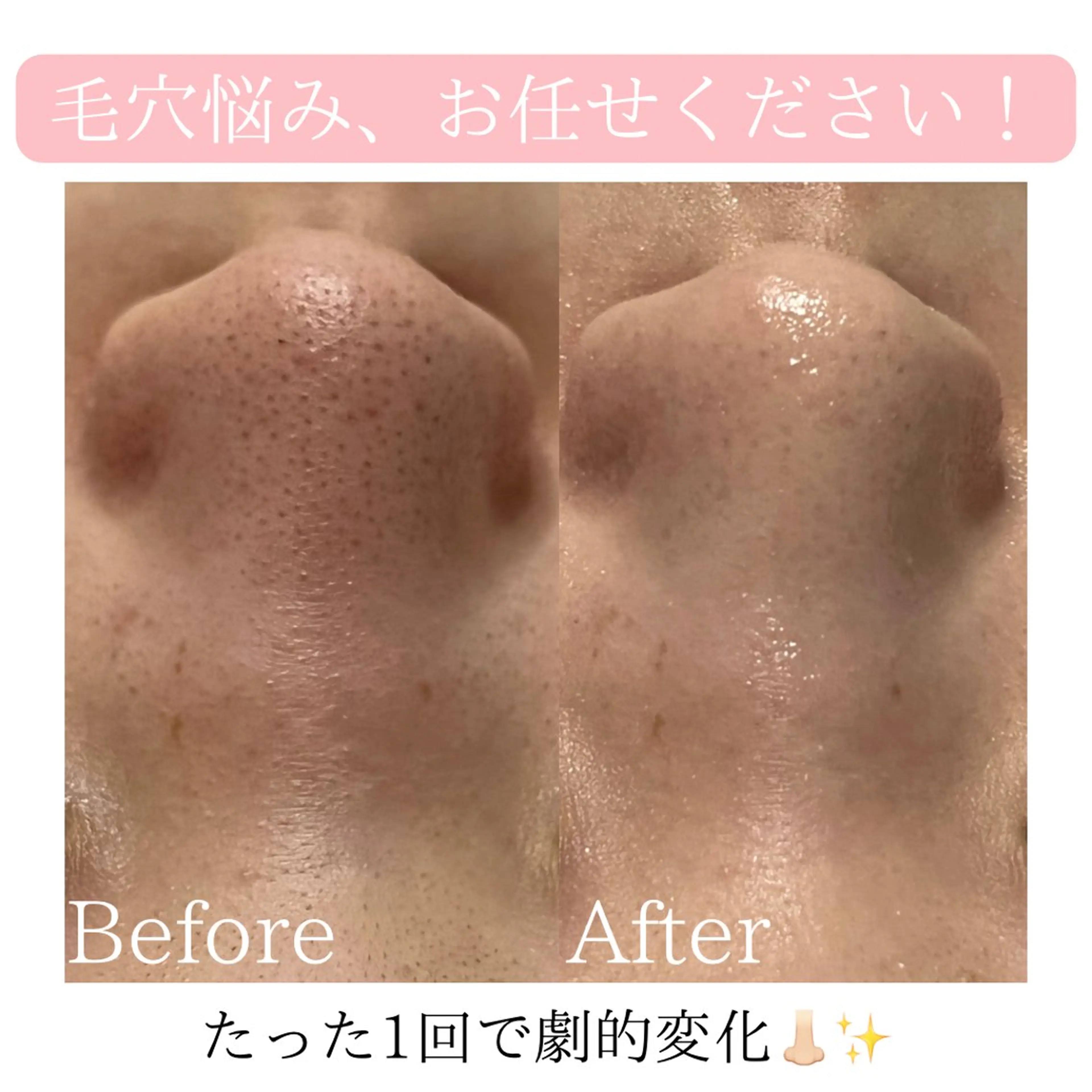 【明日17日1名様限定】即日実感✨全顔毛穴洗浄×美容液で毛穴レス肌へ【黒ずみ毛穴/詰まり毛穴に◎】の写真