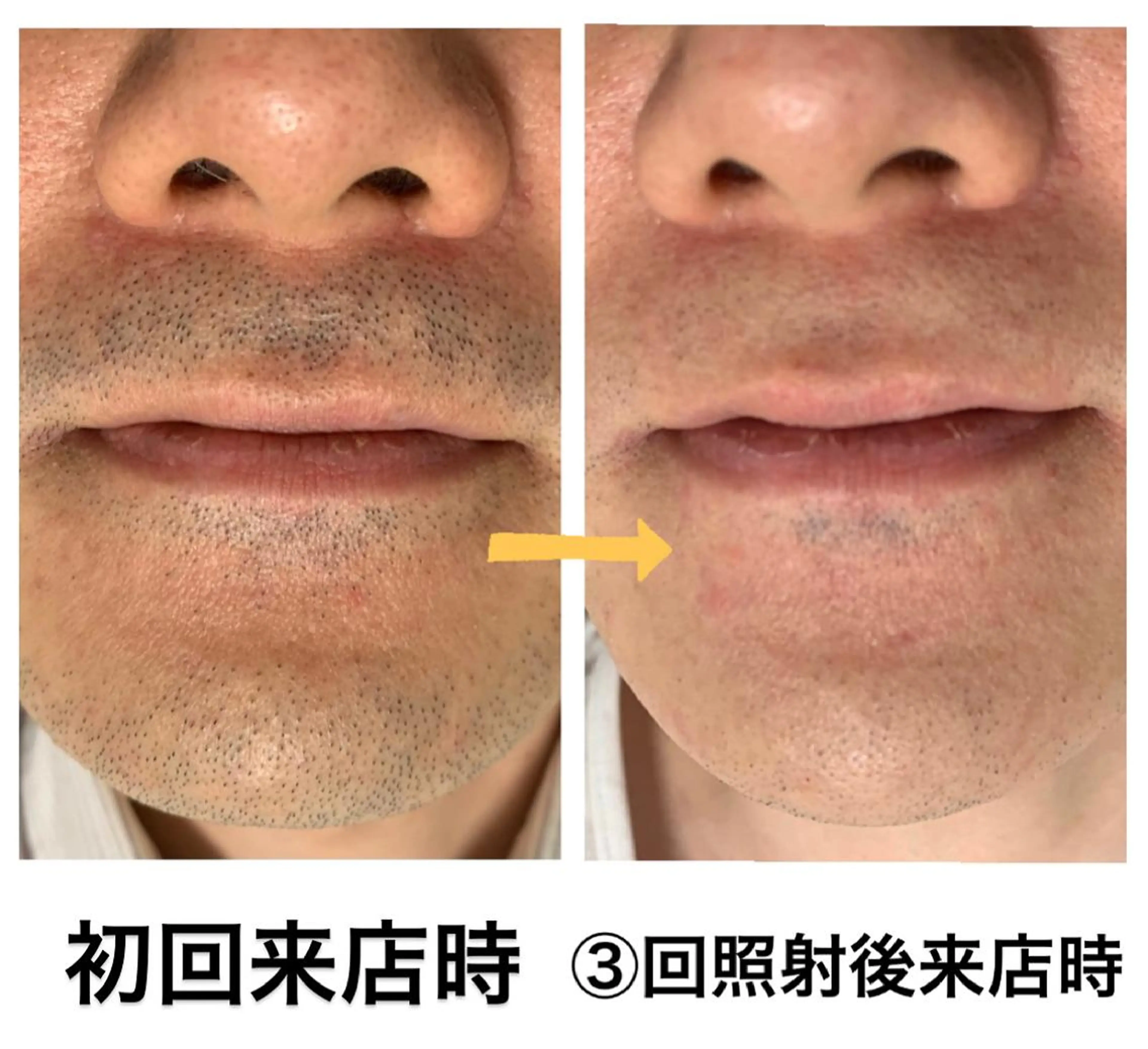 脱毛 メンズ脱毛サロン Le falcoのエステ・リラクイメージ