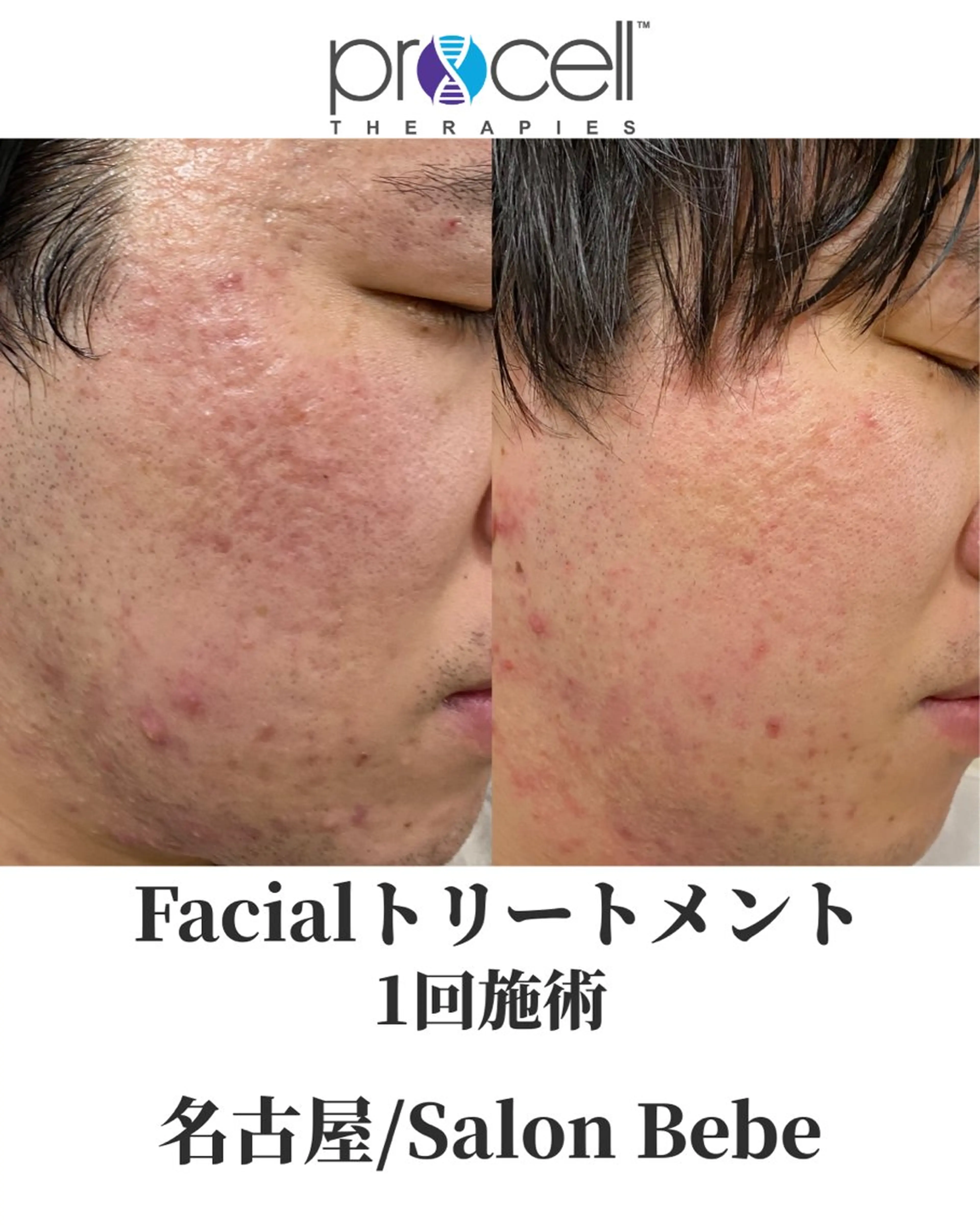 【初回特別20%OFF】通常¥50,000→¥40,000｜マスクなし、ノーファンデでハリ艶肌への写真