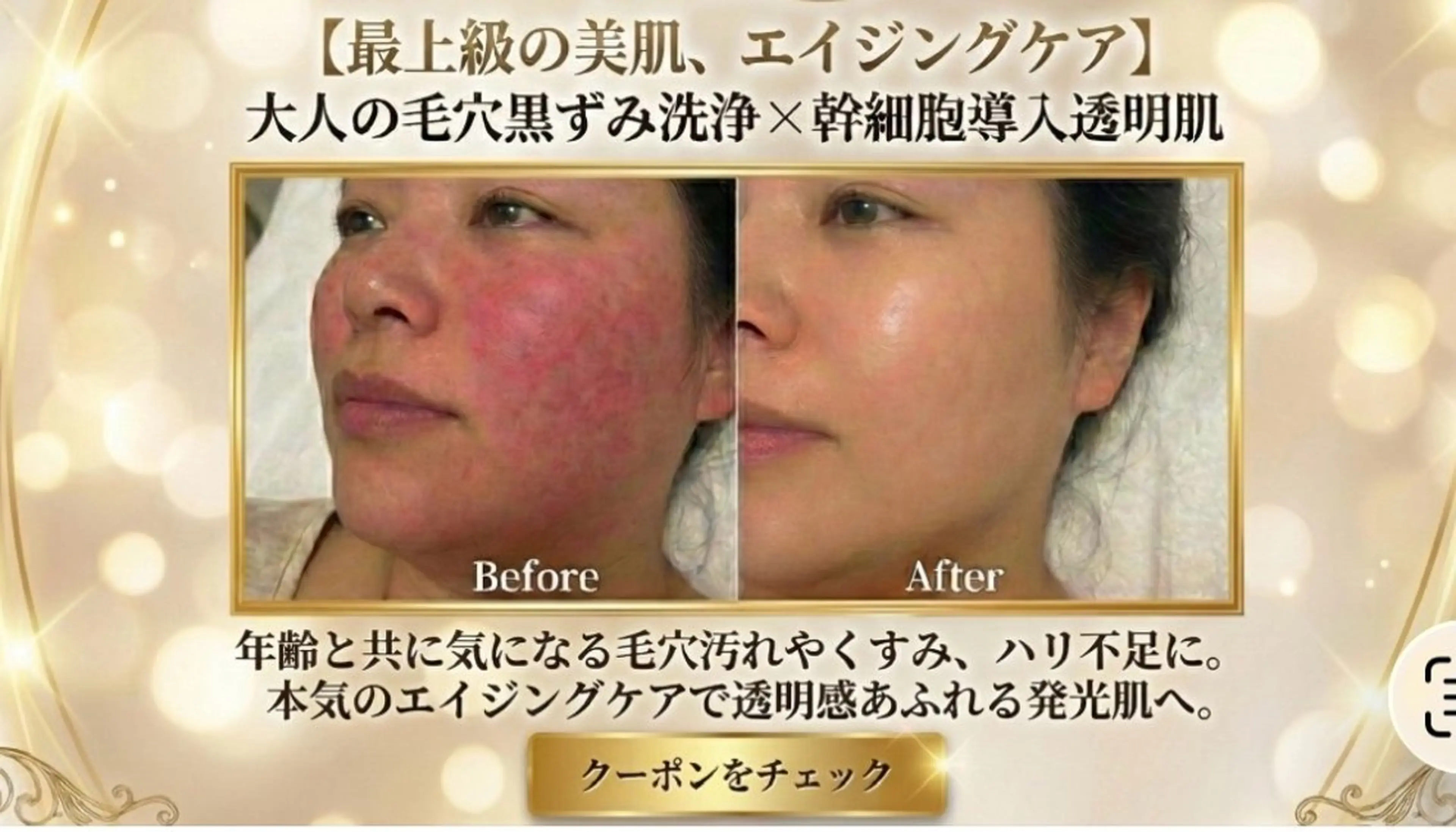 【毛穴×美白】大人の黒ずみ洗浄＋高濃度ヒト幹細胞｜陶器肌・エイジングケア・ざらつき除去【施術60分】の写真