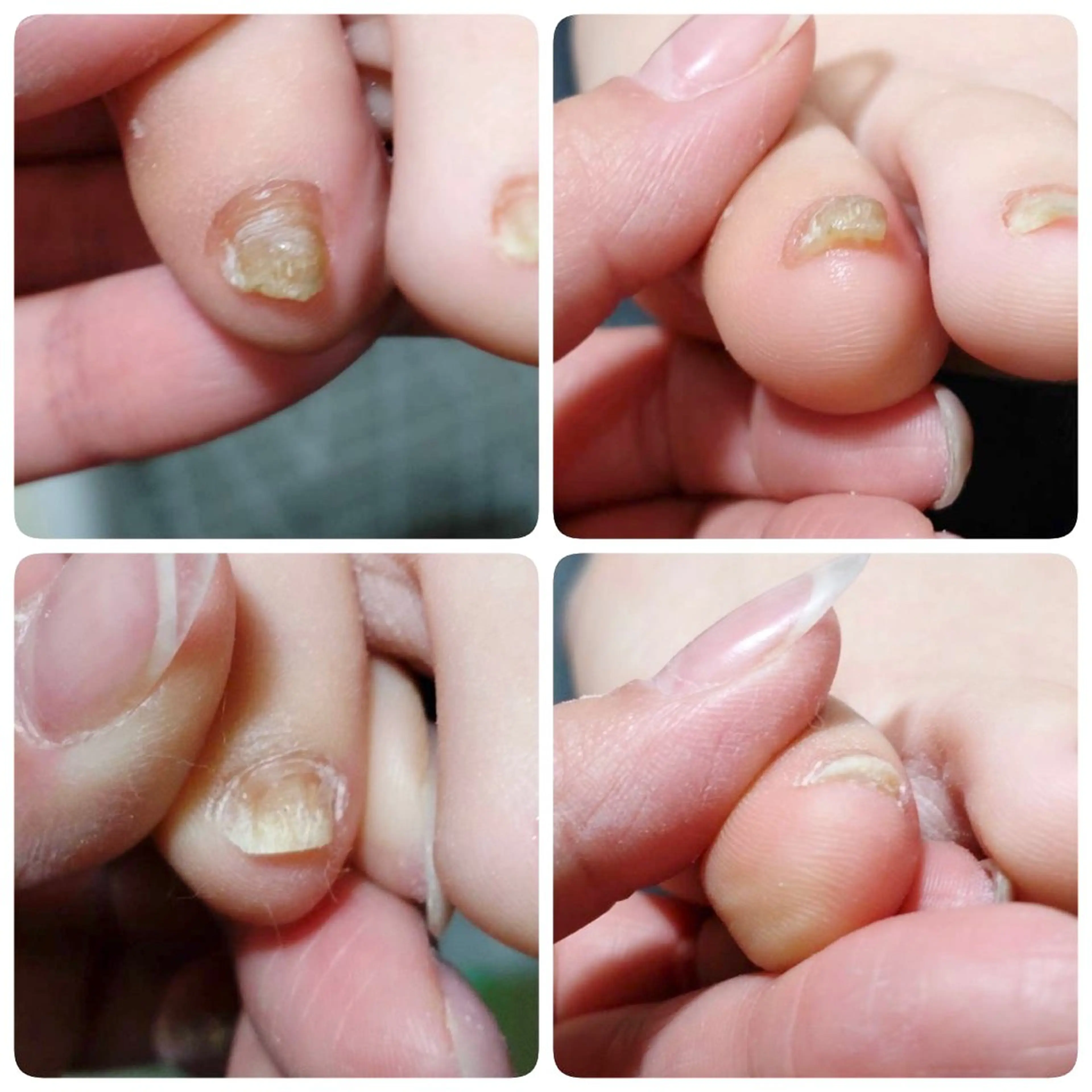 ネイル 深爪・巻き爪 専門サンセリテのネイルデザイン