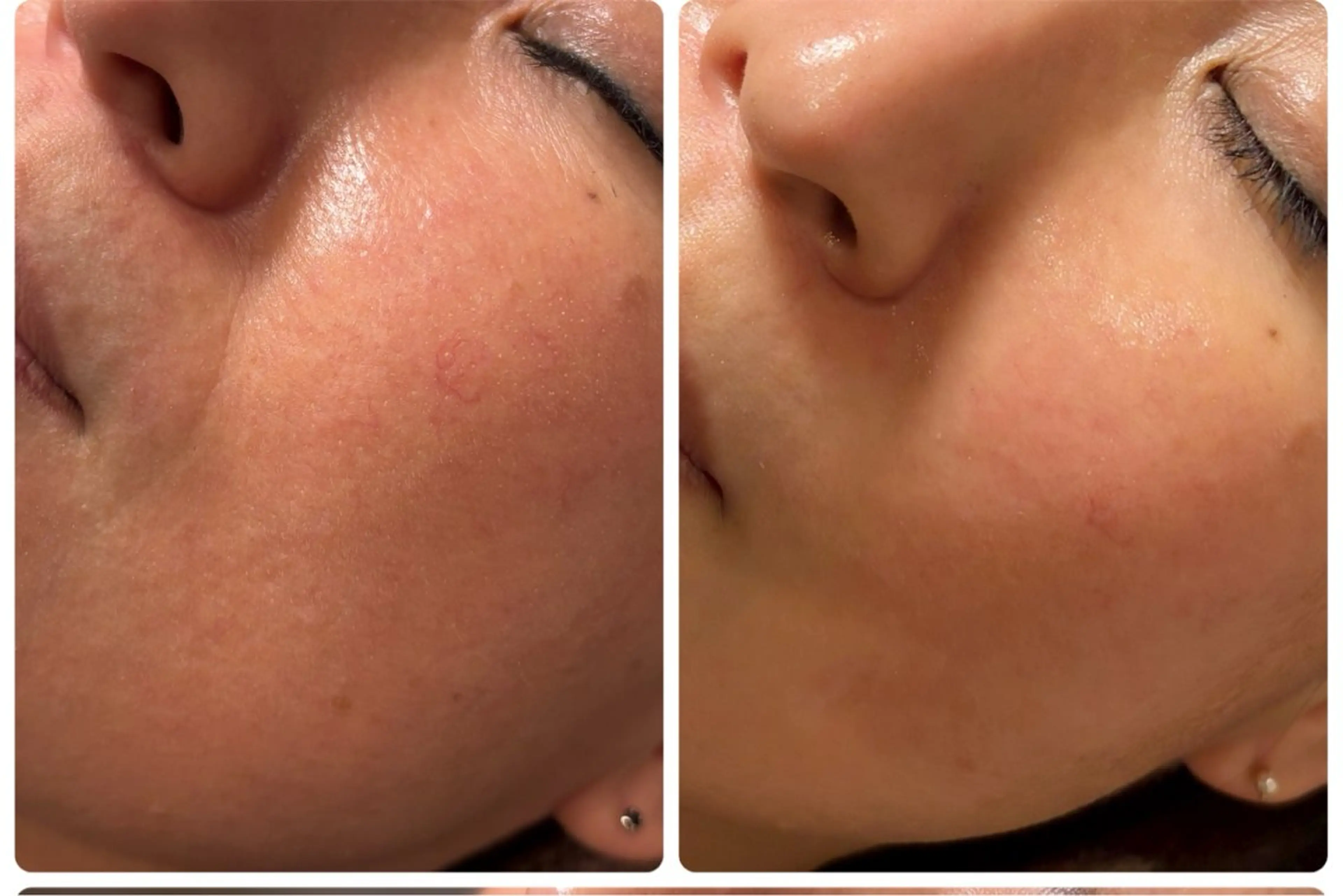 剥離なしハーブピーリング🌿.∘の写真