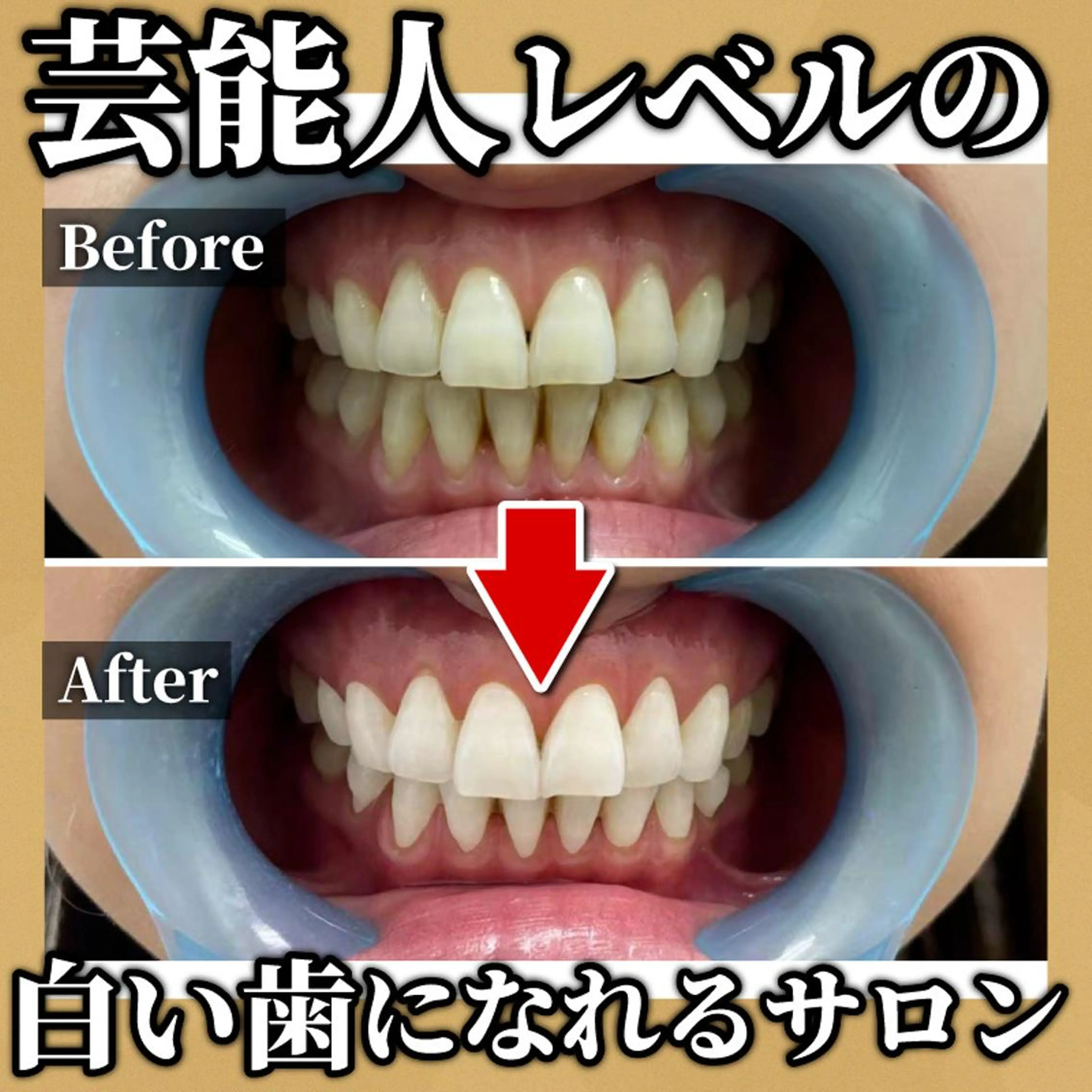 セルフホワイトニング64分照射コースの写真