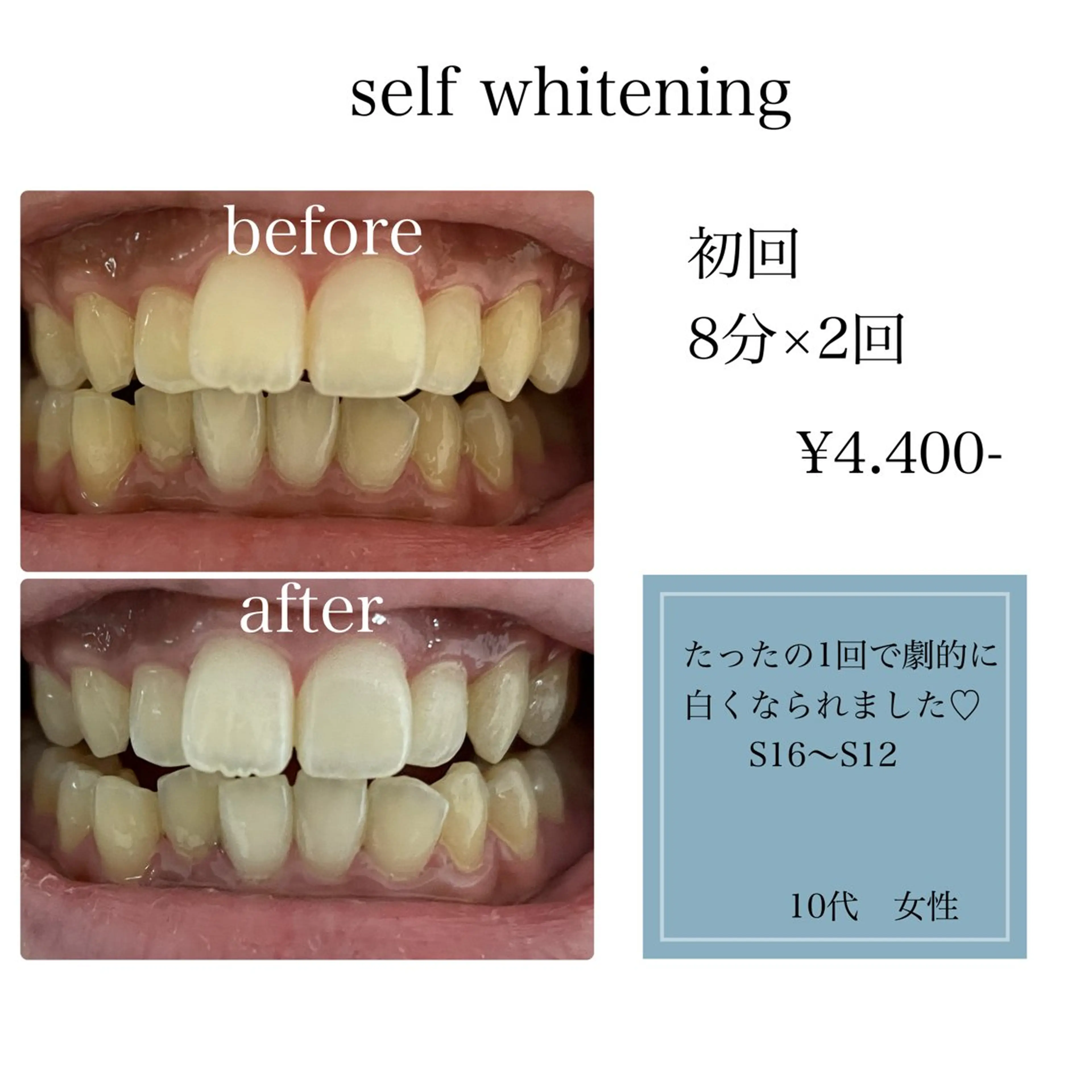セルフホワイトニング8分×2回の写真