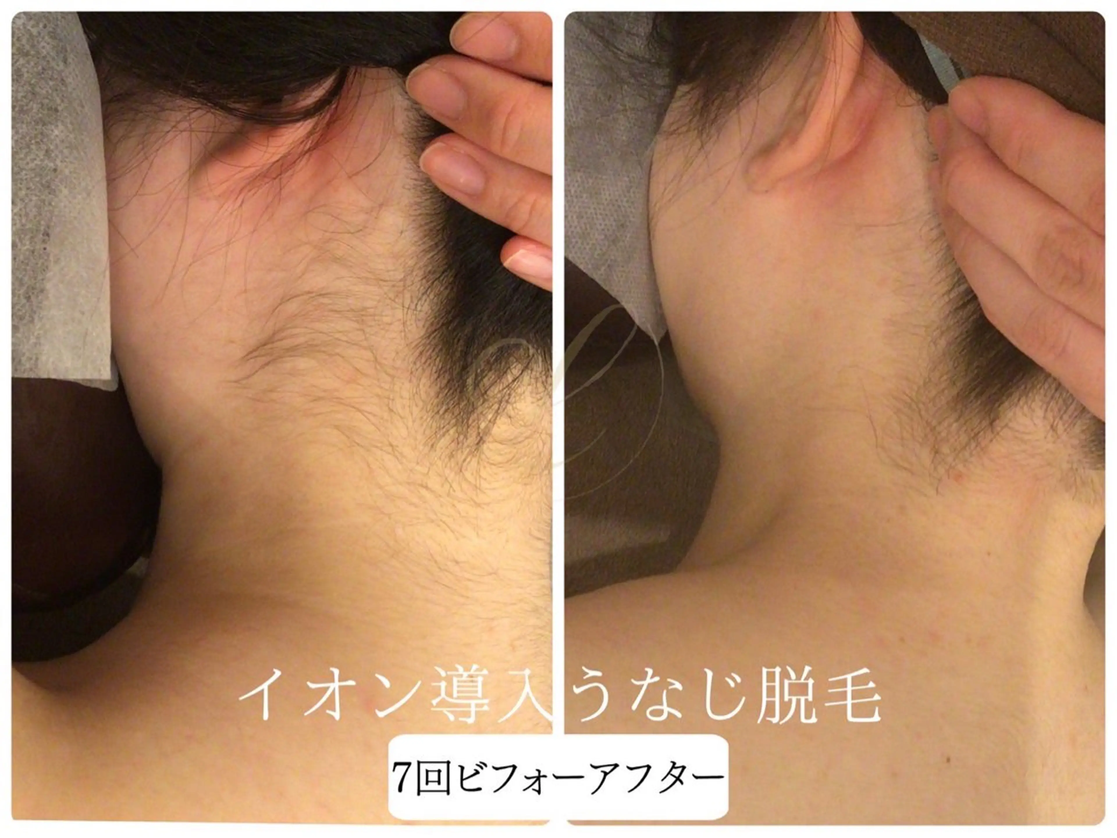 脱毛 Beauty  salon Lino所属・🎀うなじ脱毛🎀 ㅣLino堀江のエステ・リラクイメージ