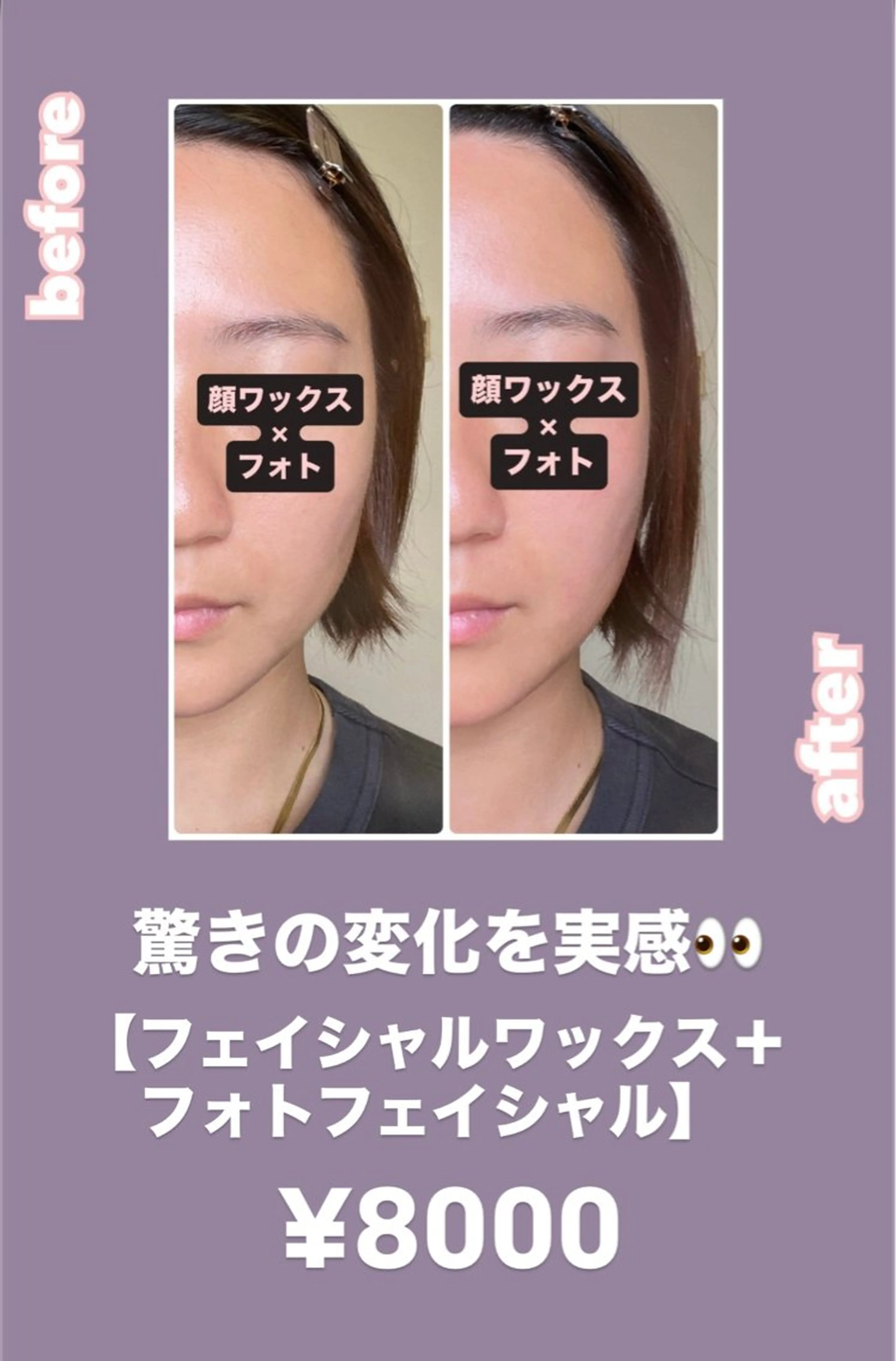 そのゴワついた肌☠️ 素肌から自信を取り戻す✊つるんとモチモチ卵肌【顔ワックス+光フェイシャル＋ジェルパック】の写真