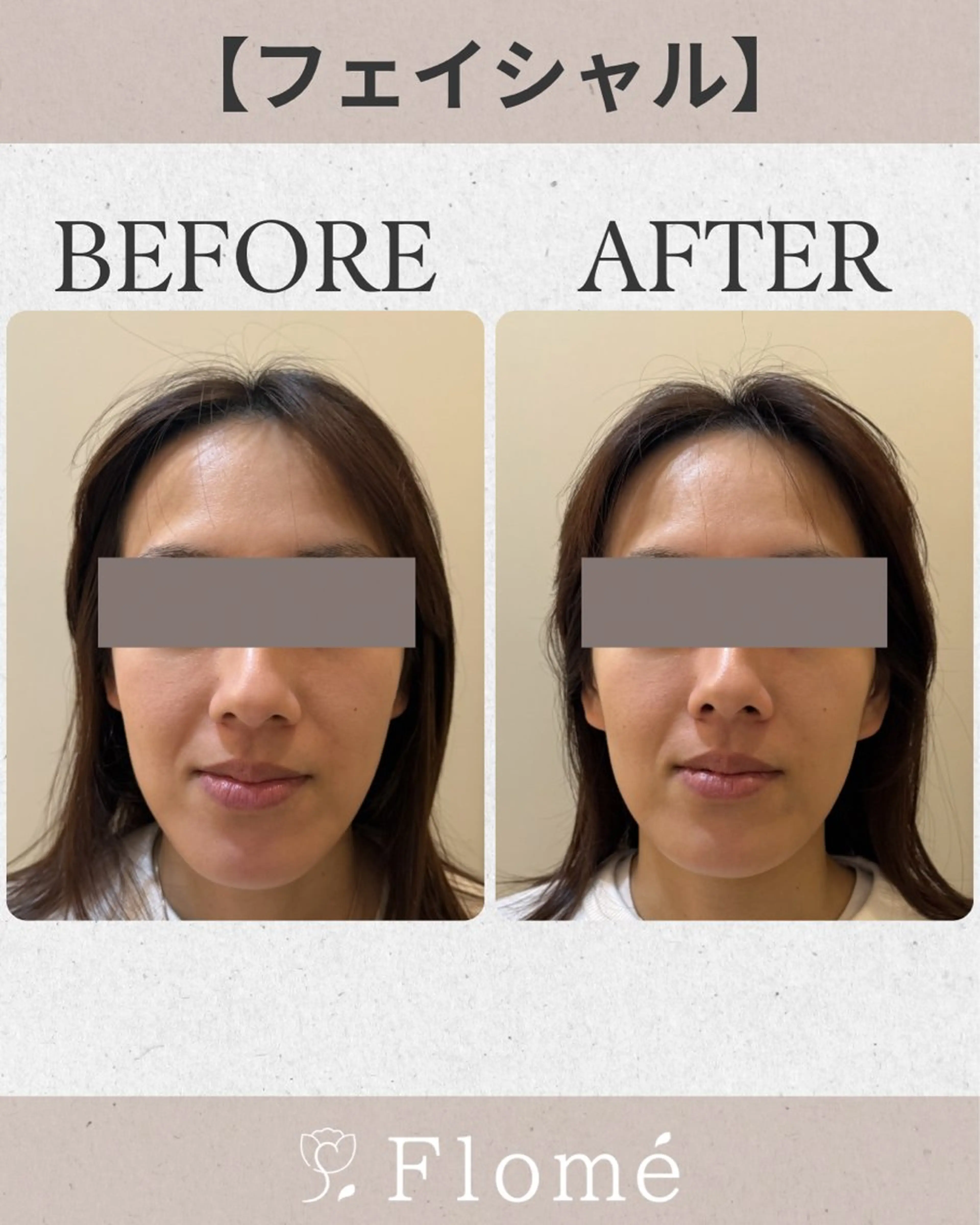 【フェイシャル】お顔からデコルテまで、アフターケアにも⭐️(お顔からデコルテまで20分)機械でアプローチの写真