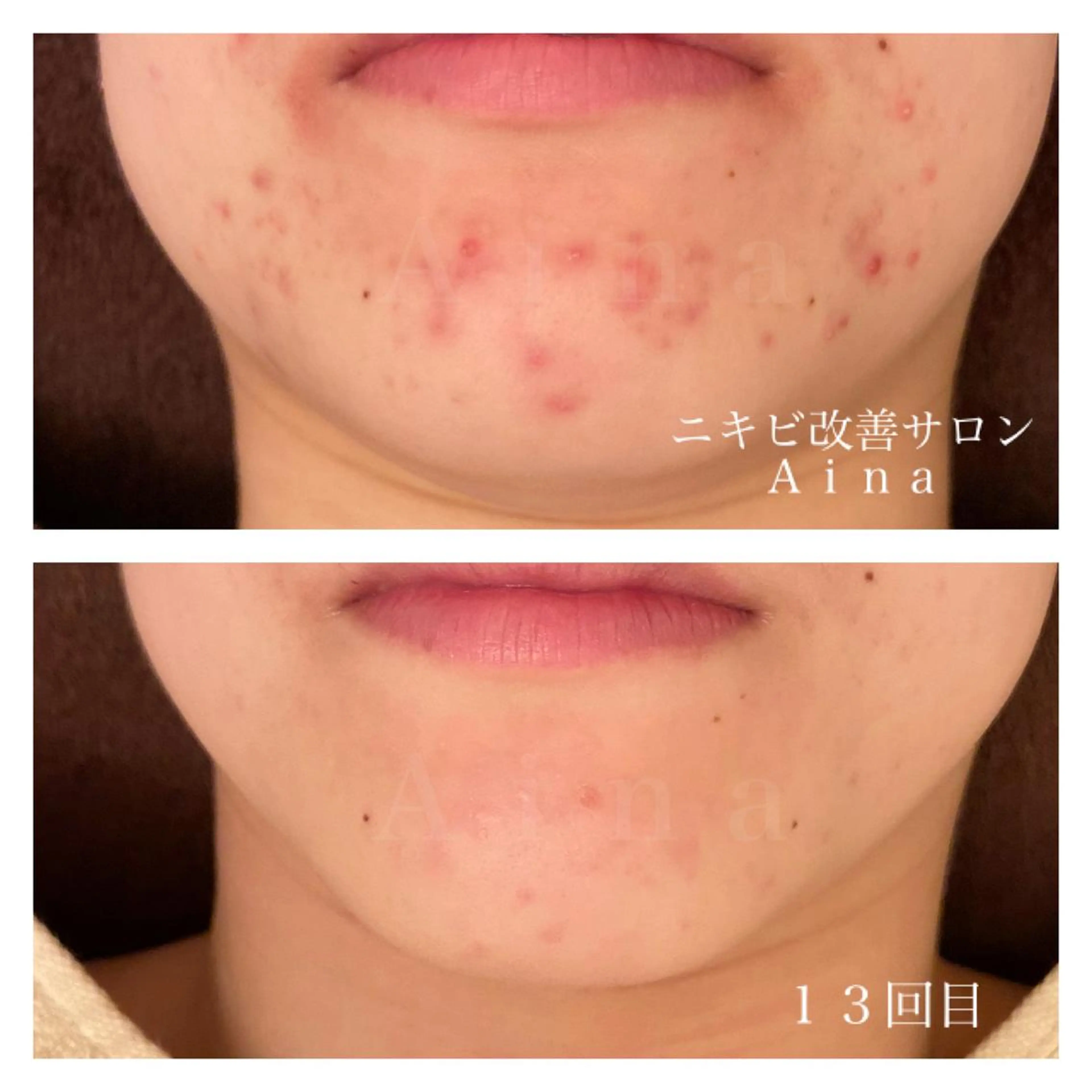 セミロング カラー パーマ ヘアアレンジ メンズ キッズ ネイル マツエク・マツパ ニキビ跡専門サロン Ａｉｎａのエステ・リラクイメージ