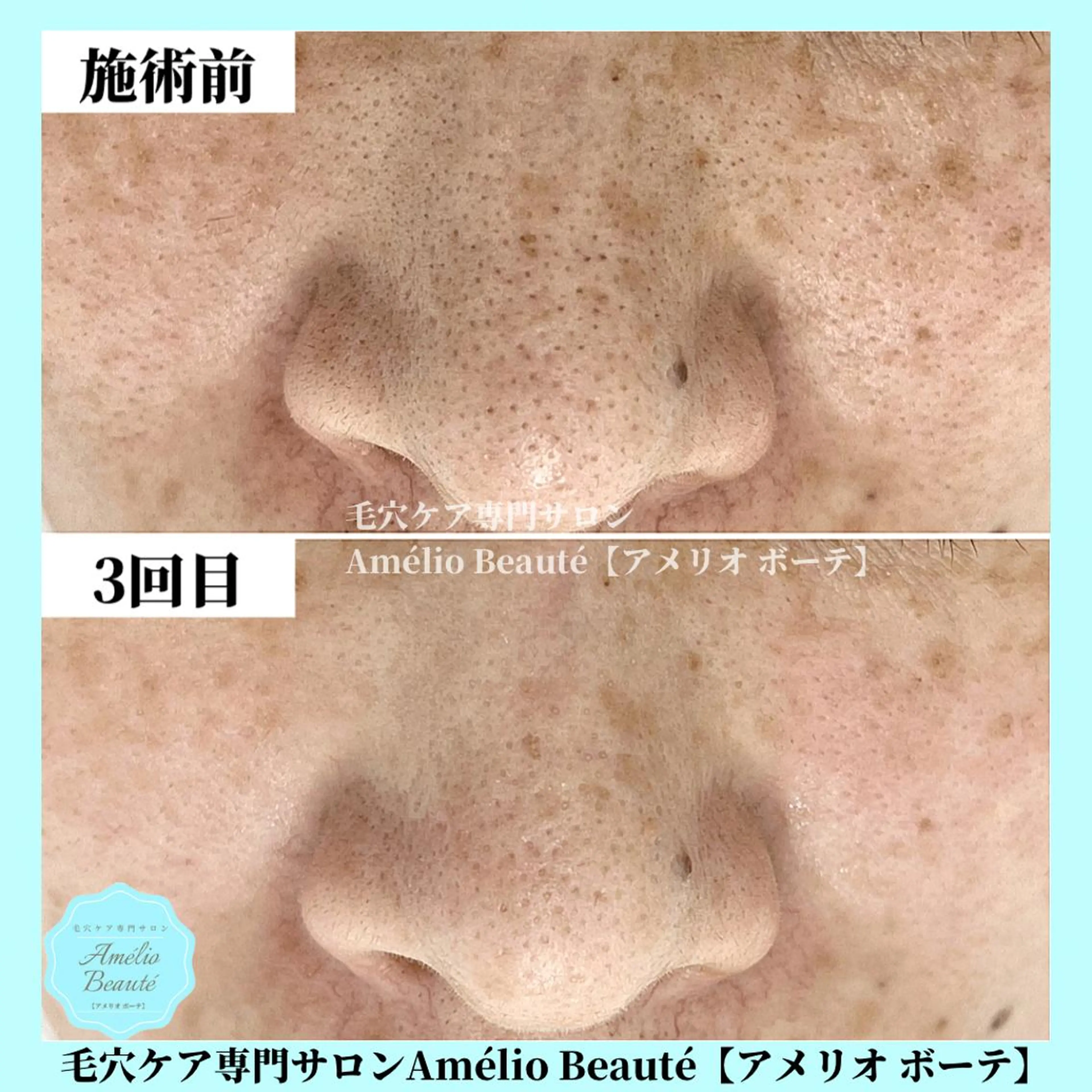 毛穴ケア専門サロン Amélio Beauté所属・毛穴ケア専門サロン アメリオボーテのその他イメージ