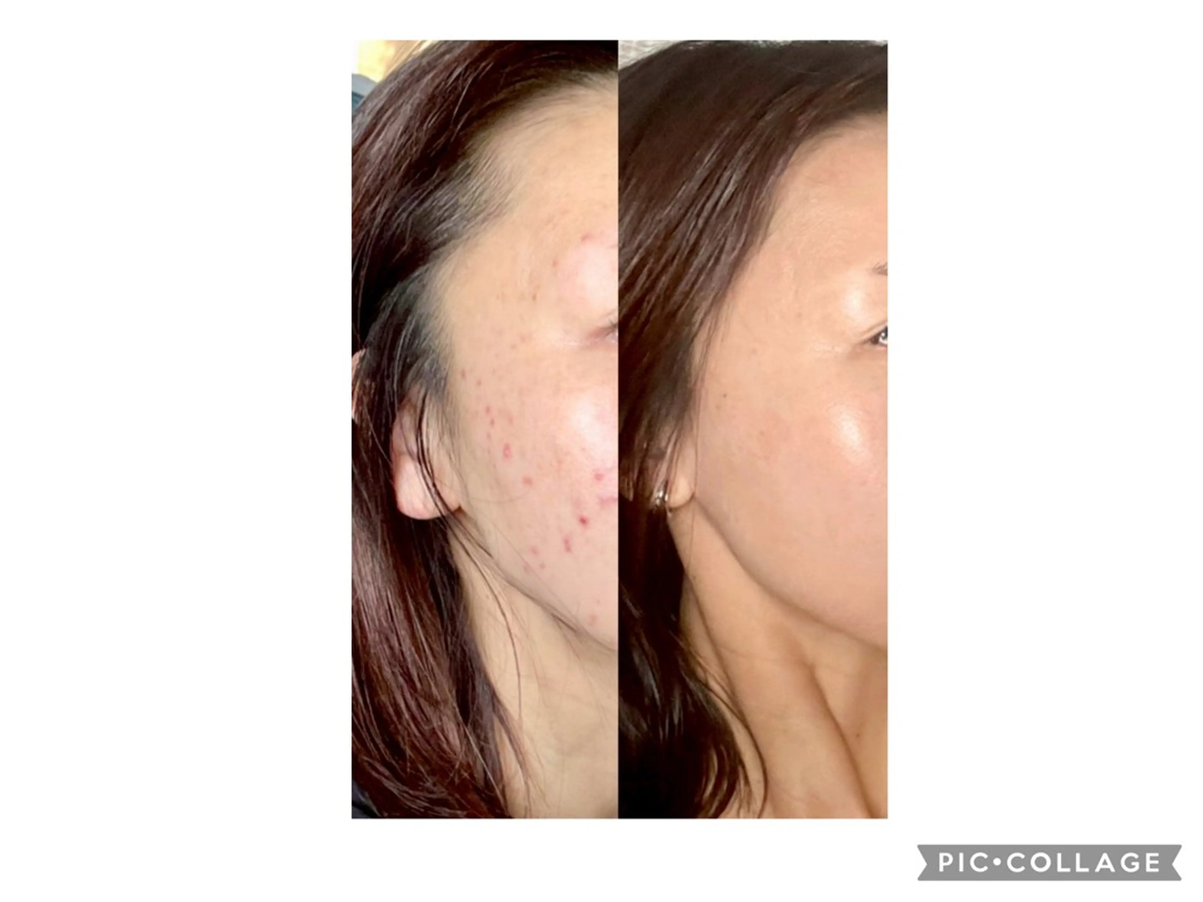 3月限定!!【毛穴/肌荒れ/乾燥ケア】毛穴洗浄×イオン導入×プラズマシャワーの写真