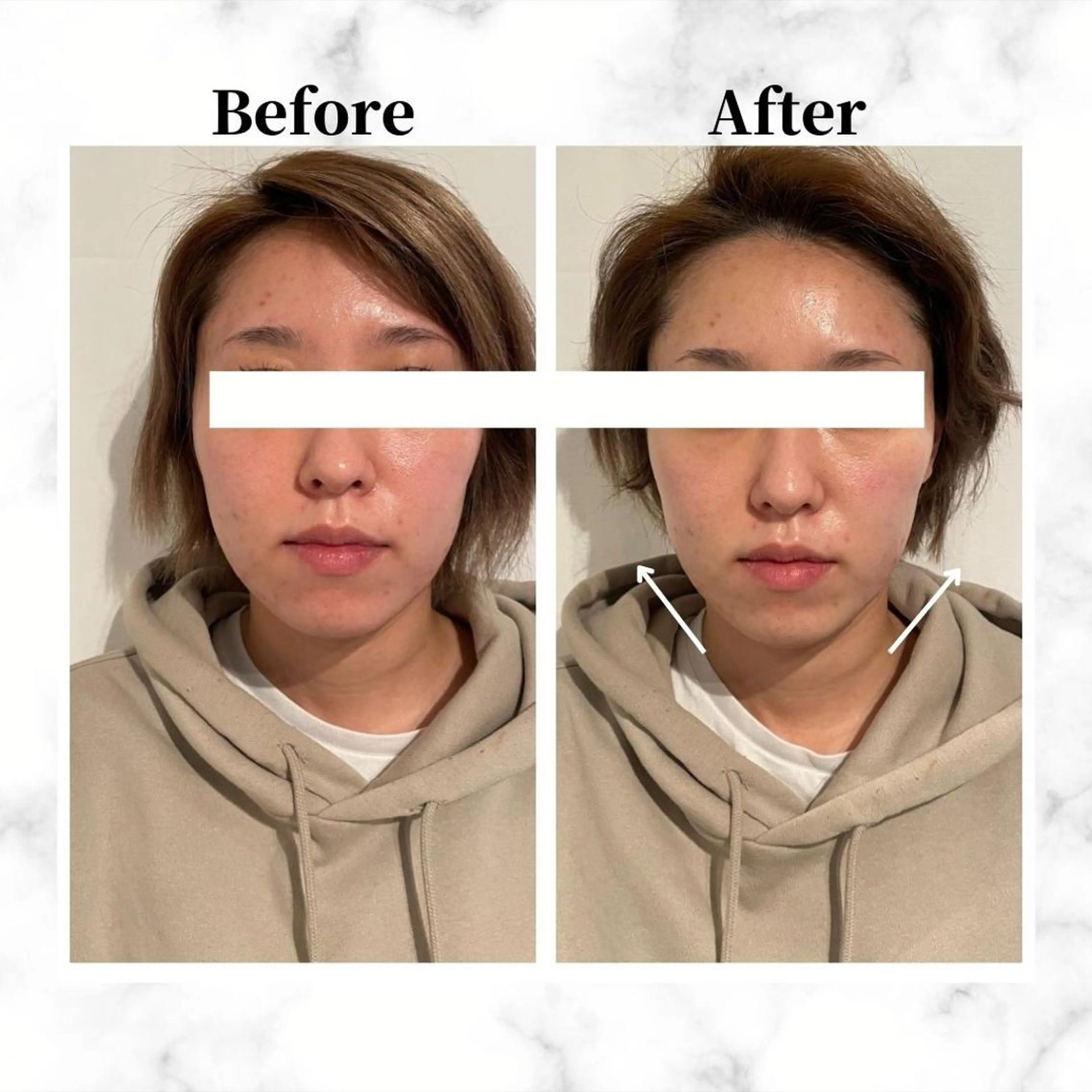 エステ リラク 12Dハイフ💗 最強小顔のエステ・リラクイメージ