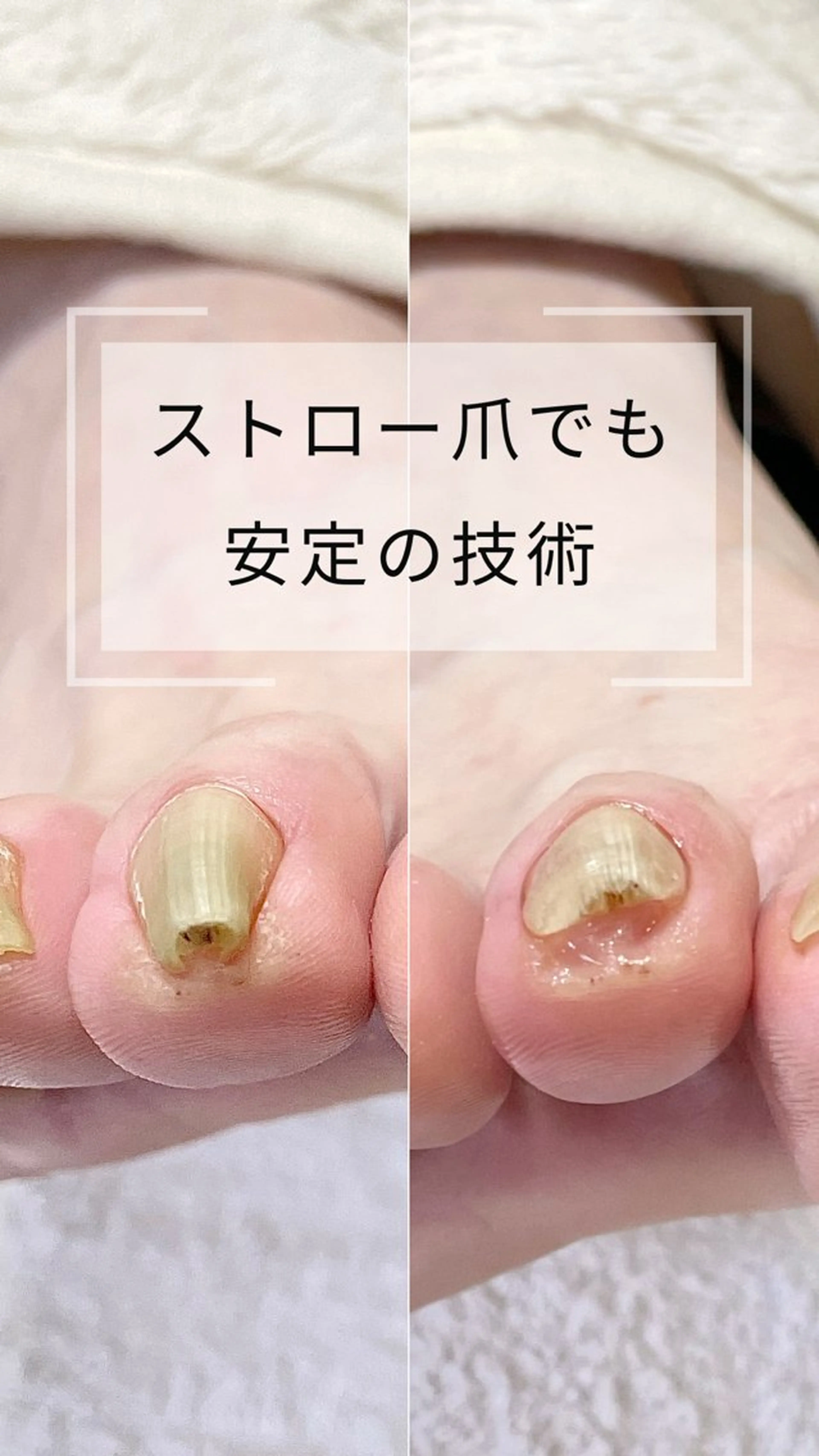 ネイル 深爪・巻き爪 専門サンセリテのネイルデザイン