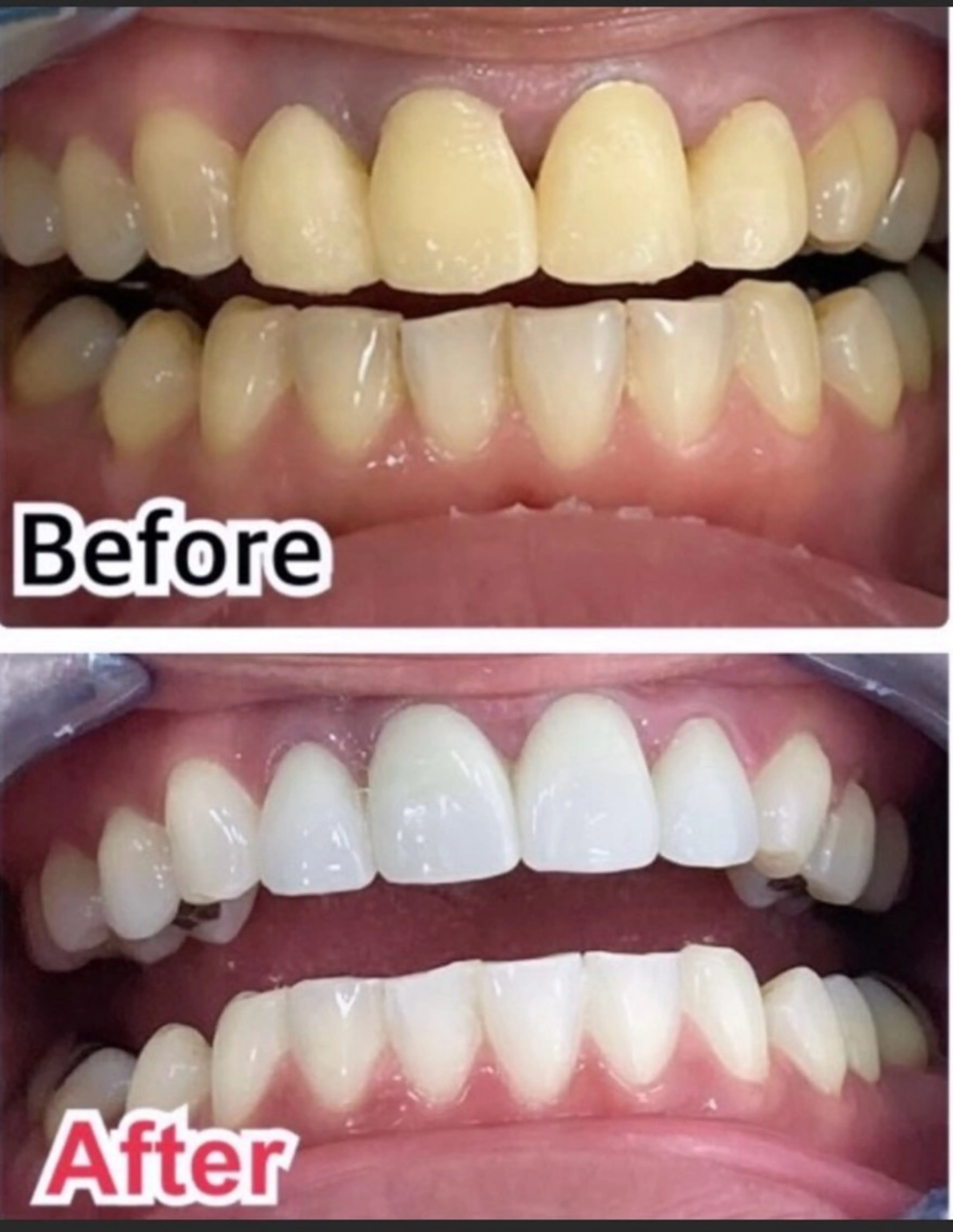 ネイル エステ プラチナムビューティー柏所属・【歯科提携】柏ホワイ トニングスタイルのその他イメージ