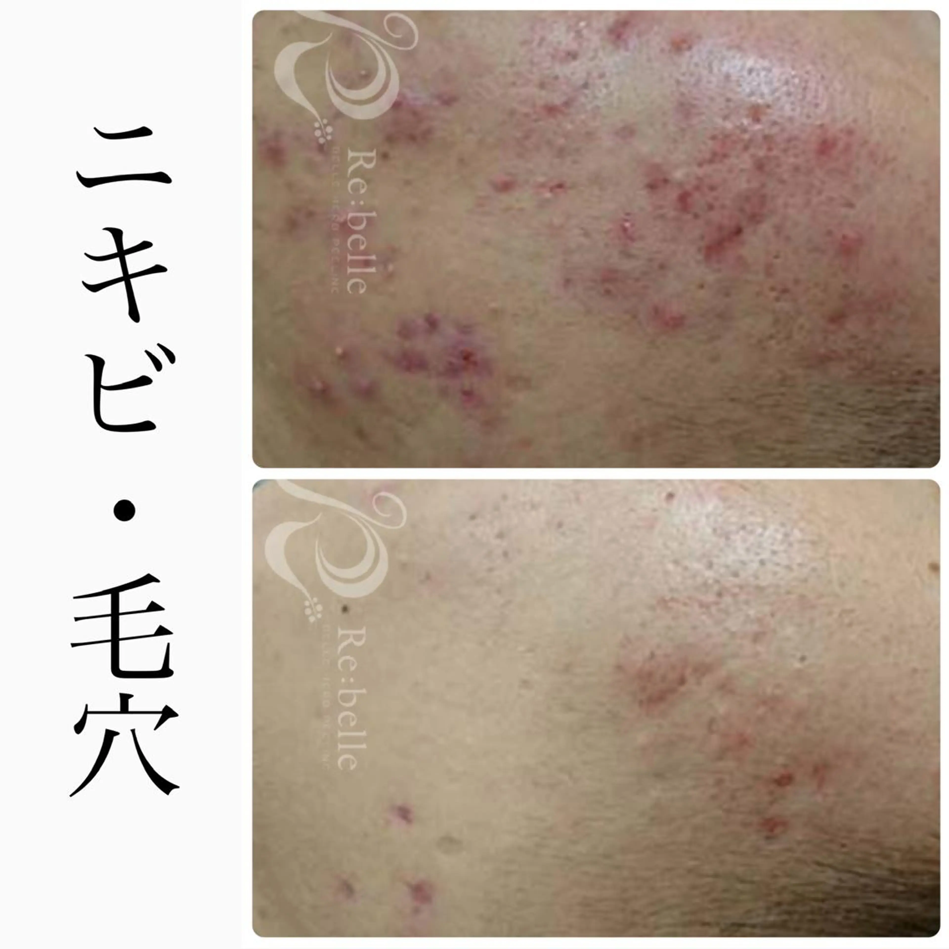 エステ BeSkin藤沢店所属・ニキビ/肌質改善 BeSkin 藤沢店のエステ・リラクイメージ