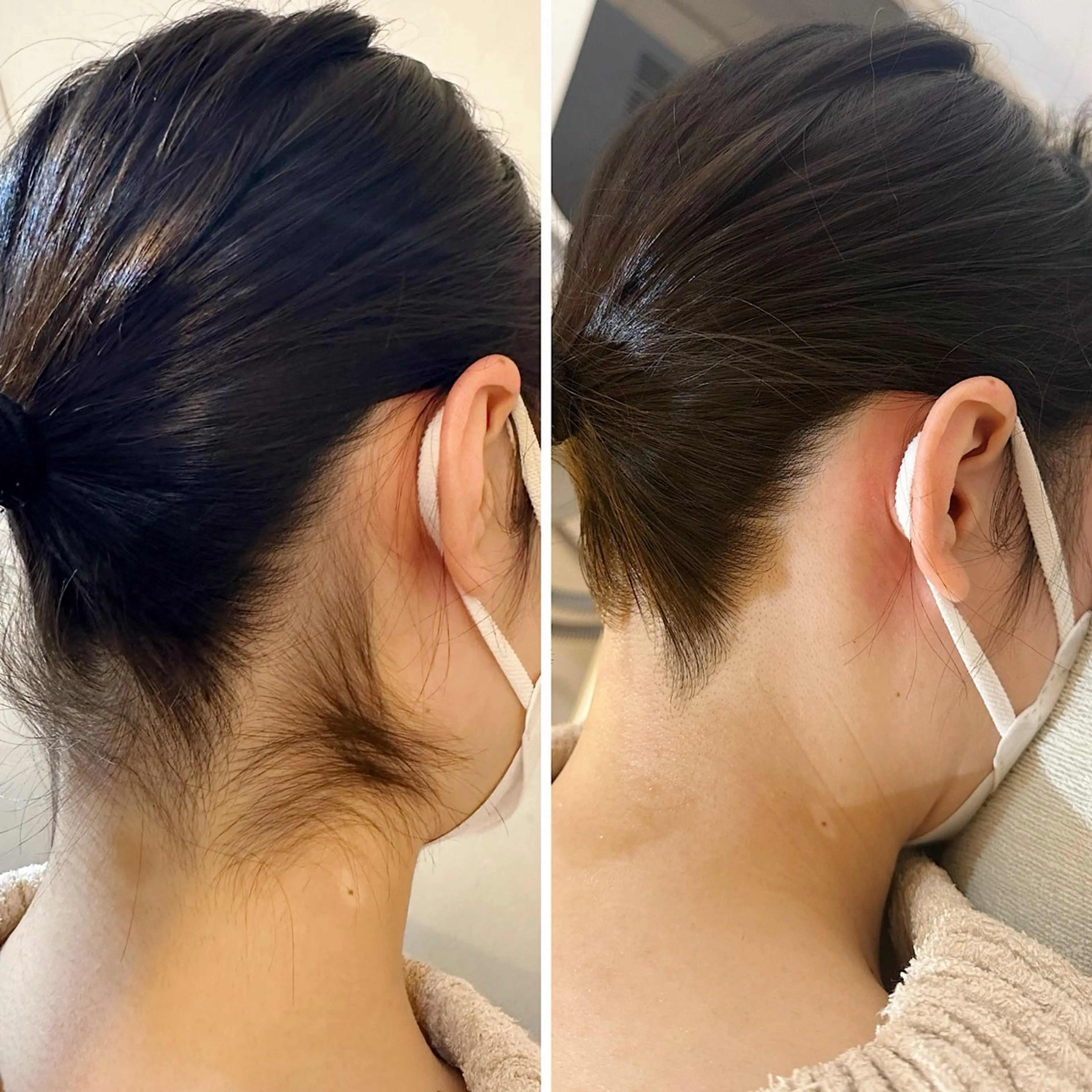 『大人気のうなじ脱毛(2回チケット)(シェービング付)』アップヘア/露出が増えるシーズンに🌻自己処理NGの写真