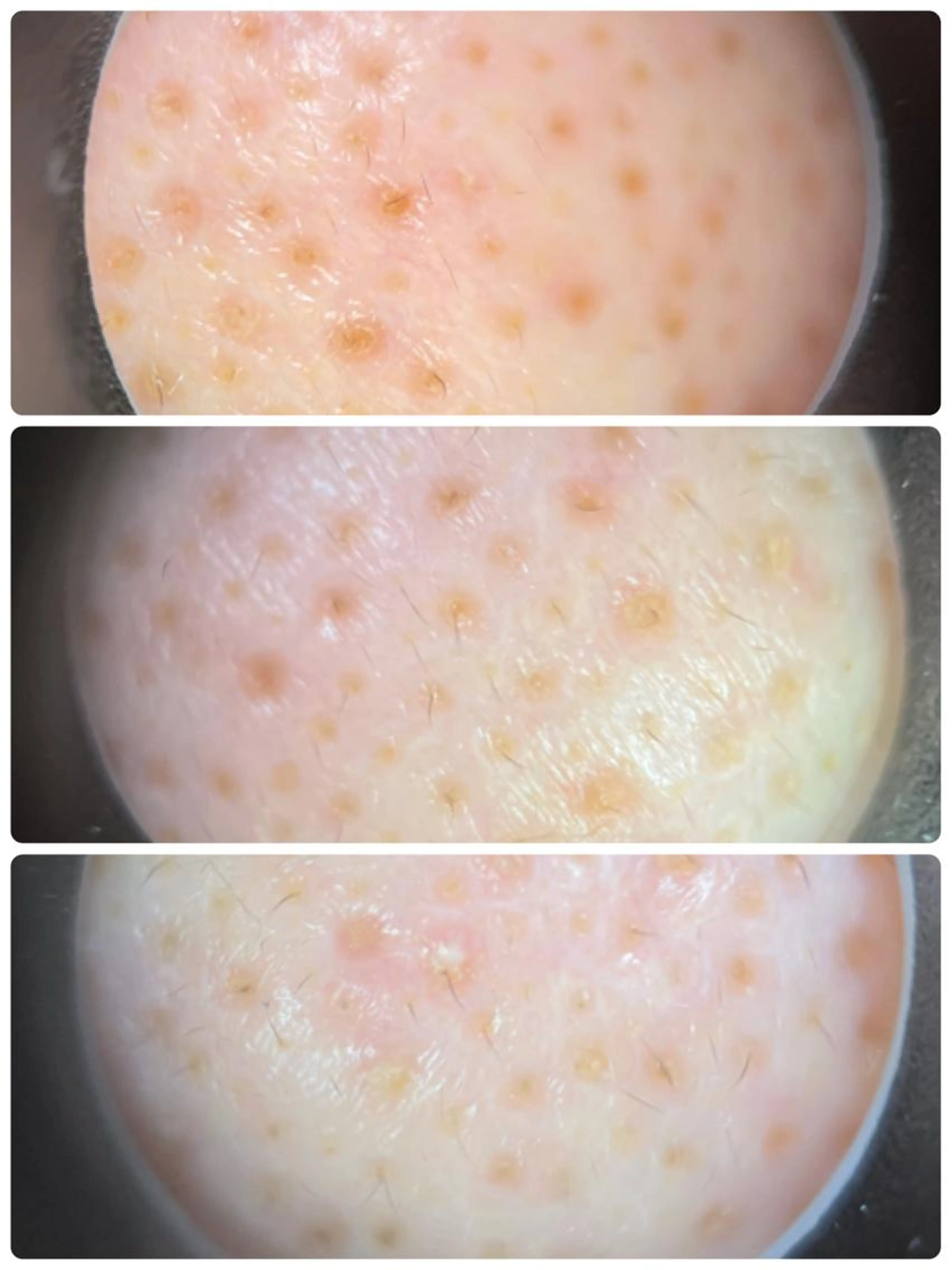 毛穴のつまりでお悩みの方におすすめ😊しっかり吸引いたします💉の写真