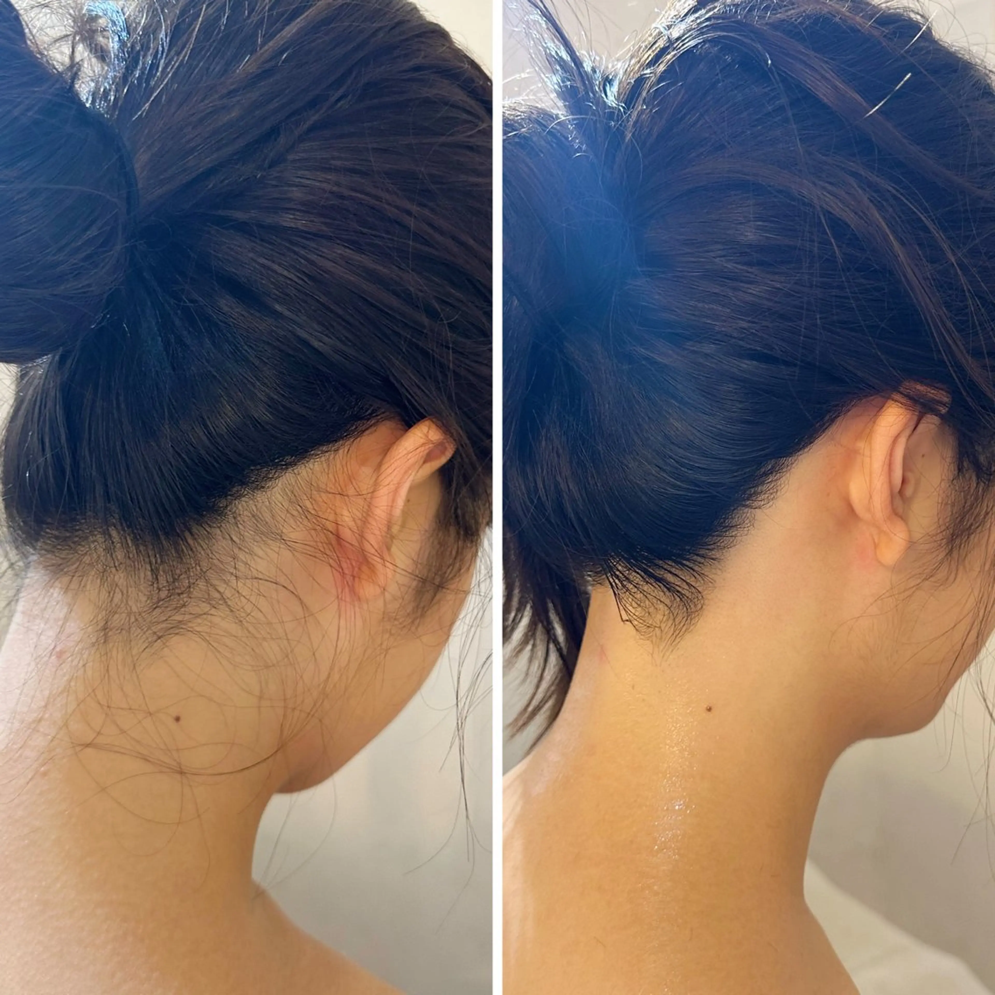 脱毛 うなじ脱毛/美肌脱毛 LABELのエステ・リラクイメージ