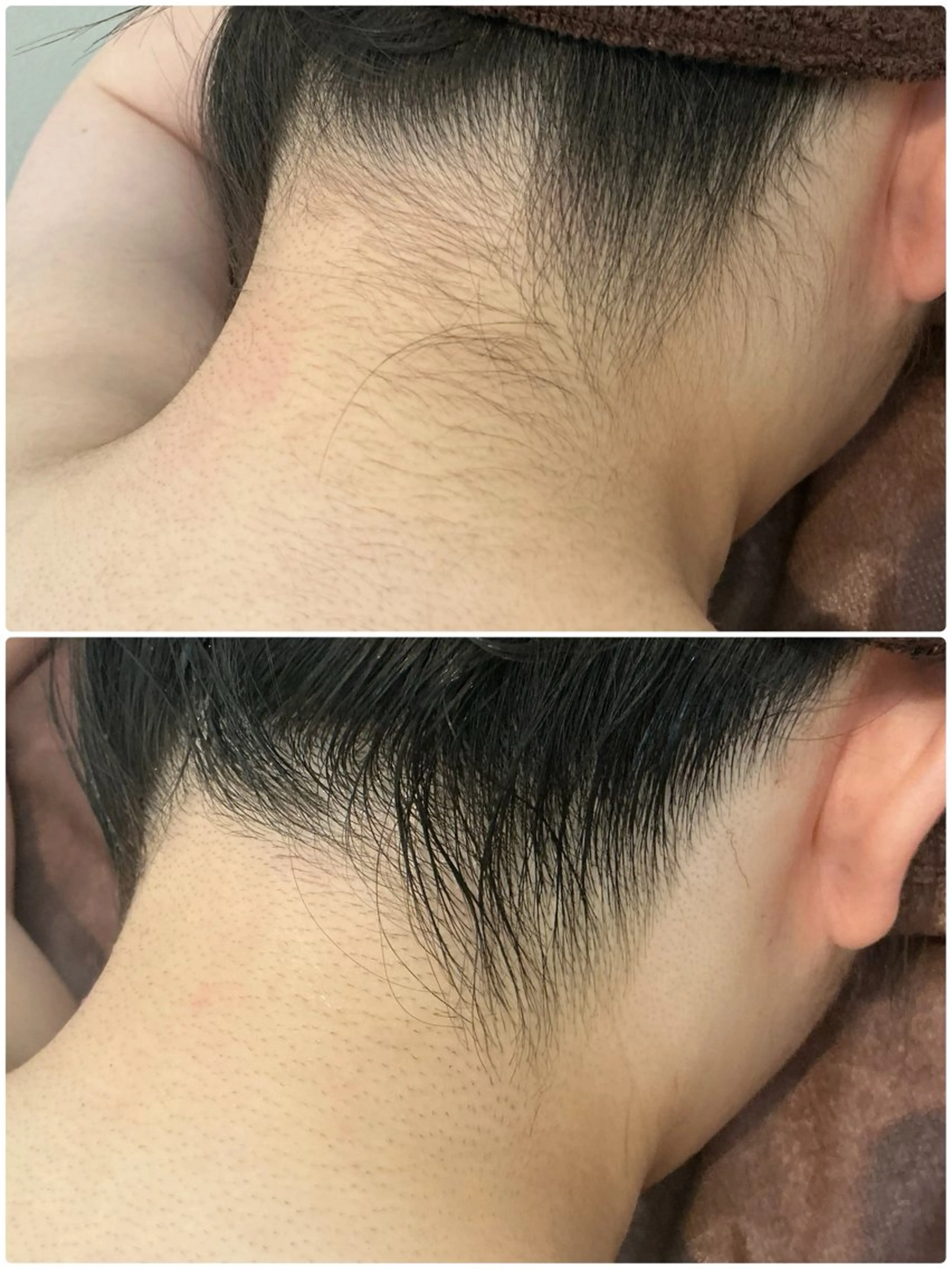 ミニモ限定🍂【背中上➕うなじ脱毛】の写真