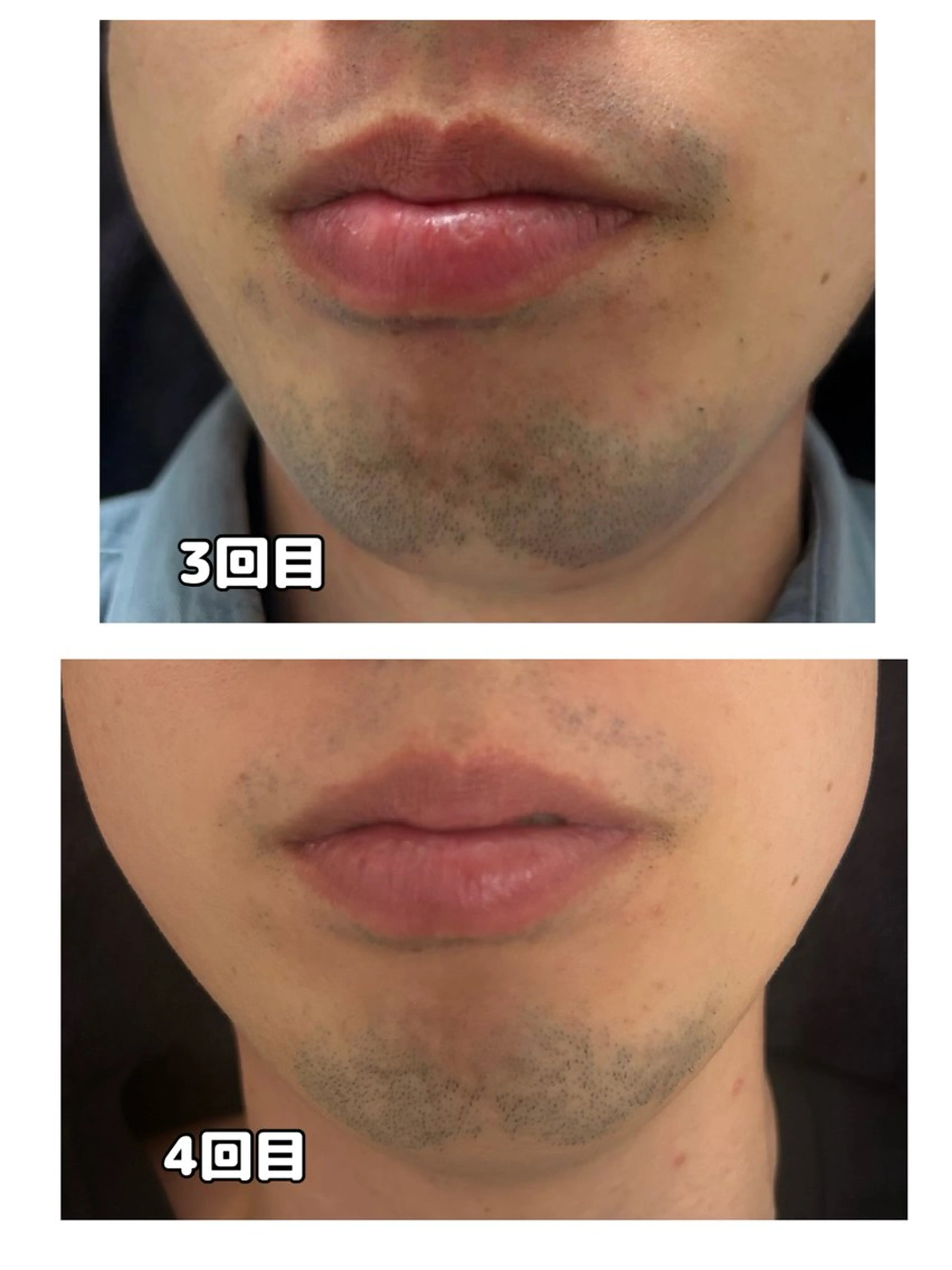 【青髭卒業！】ヒゲ脱毛 ¥4000の写真