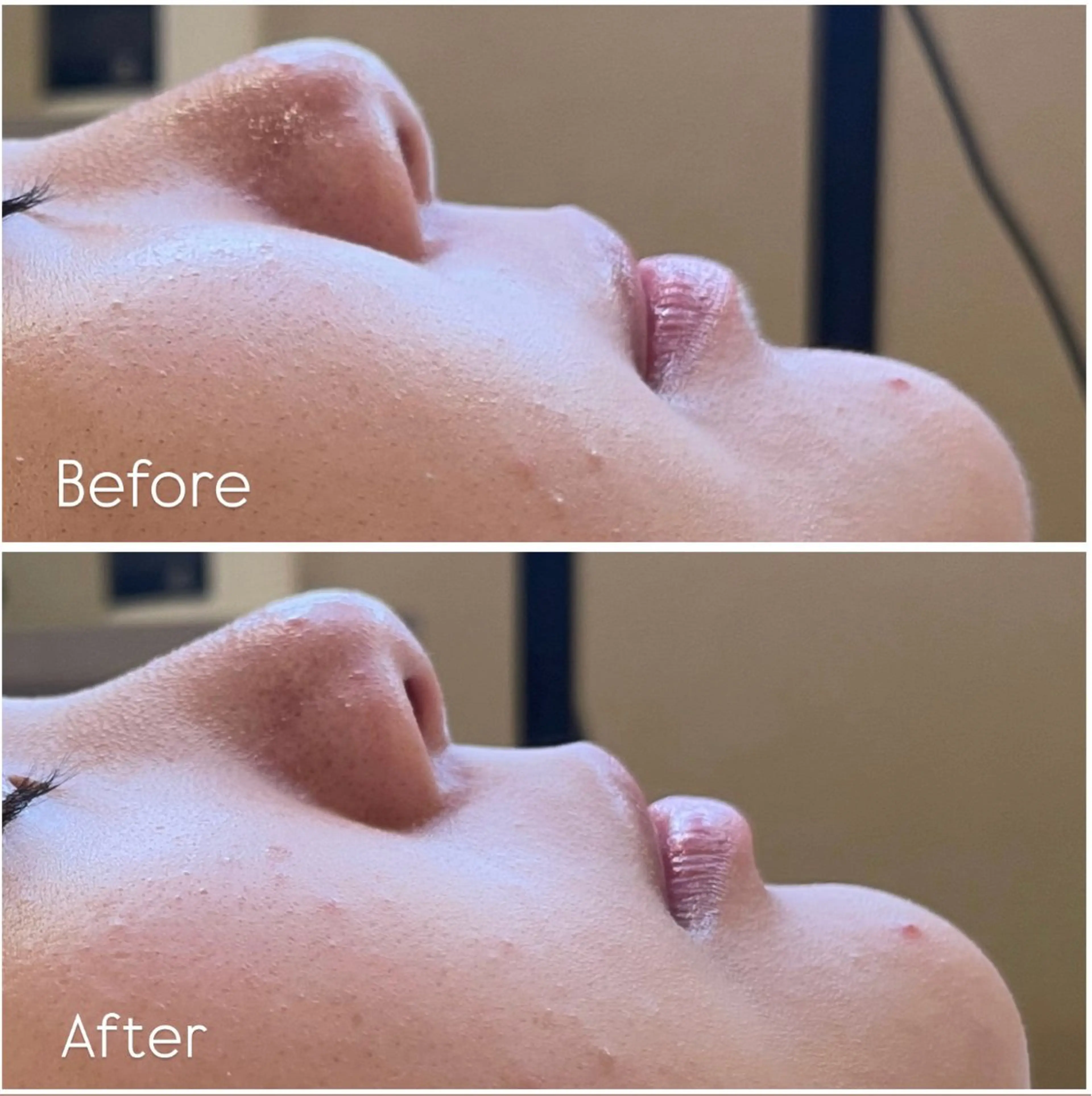 🫧フェイスシェービング🫧の写真