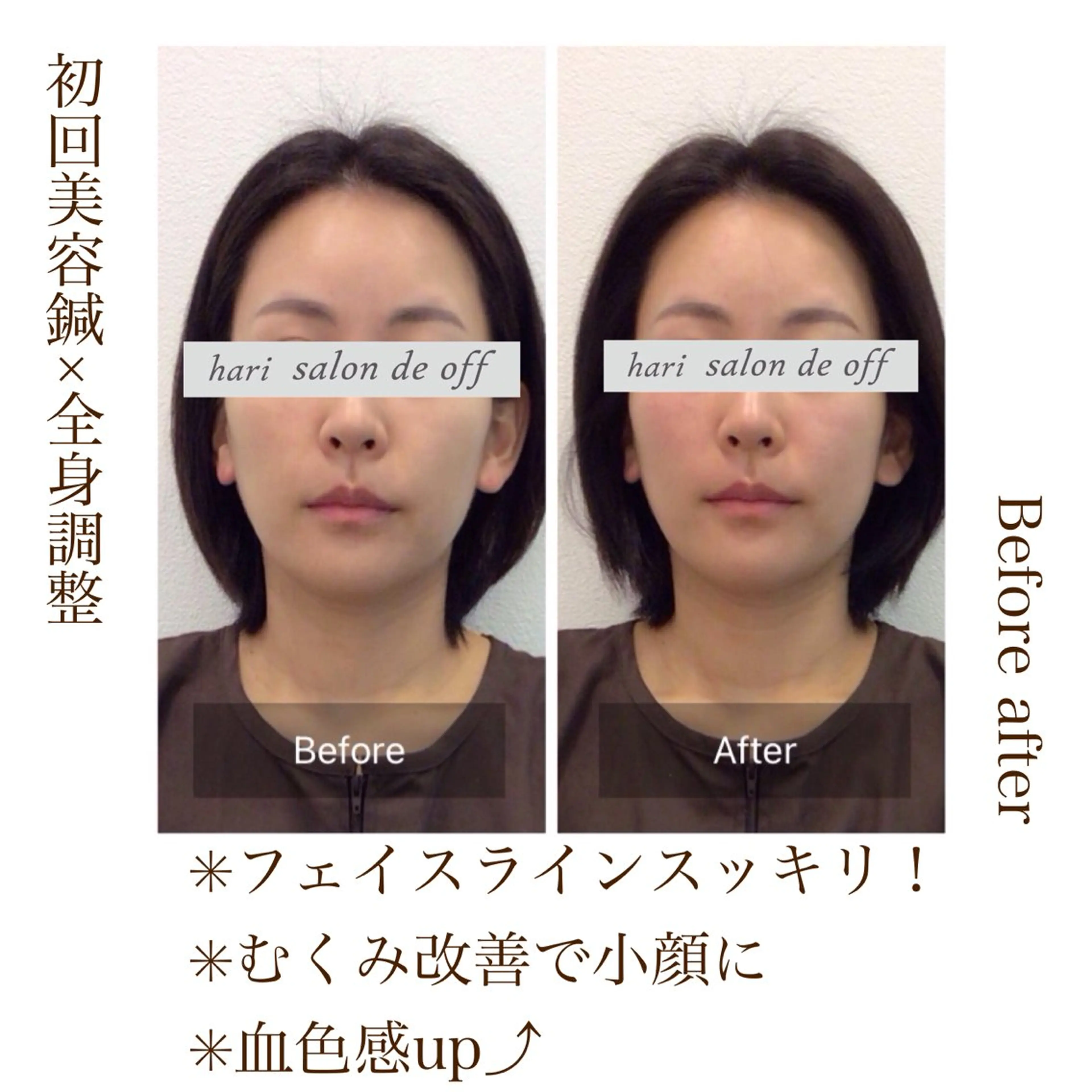 ♡当日限定♡なんと半額以下❣️【極上リッチ小顔ケア】美容鍼／リフトアップ美容鍼➕小顔矯正➕ドライヘッドスパ（60分）の写真